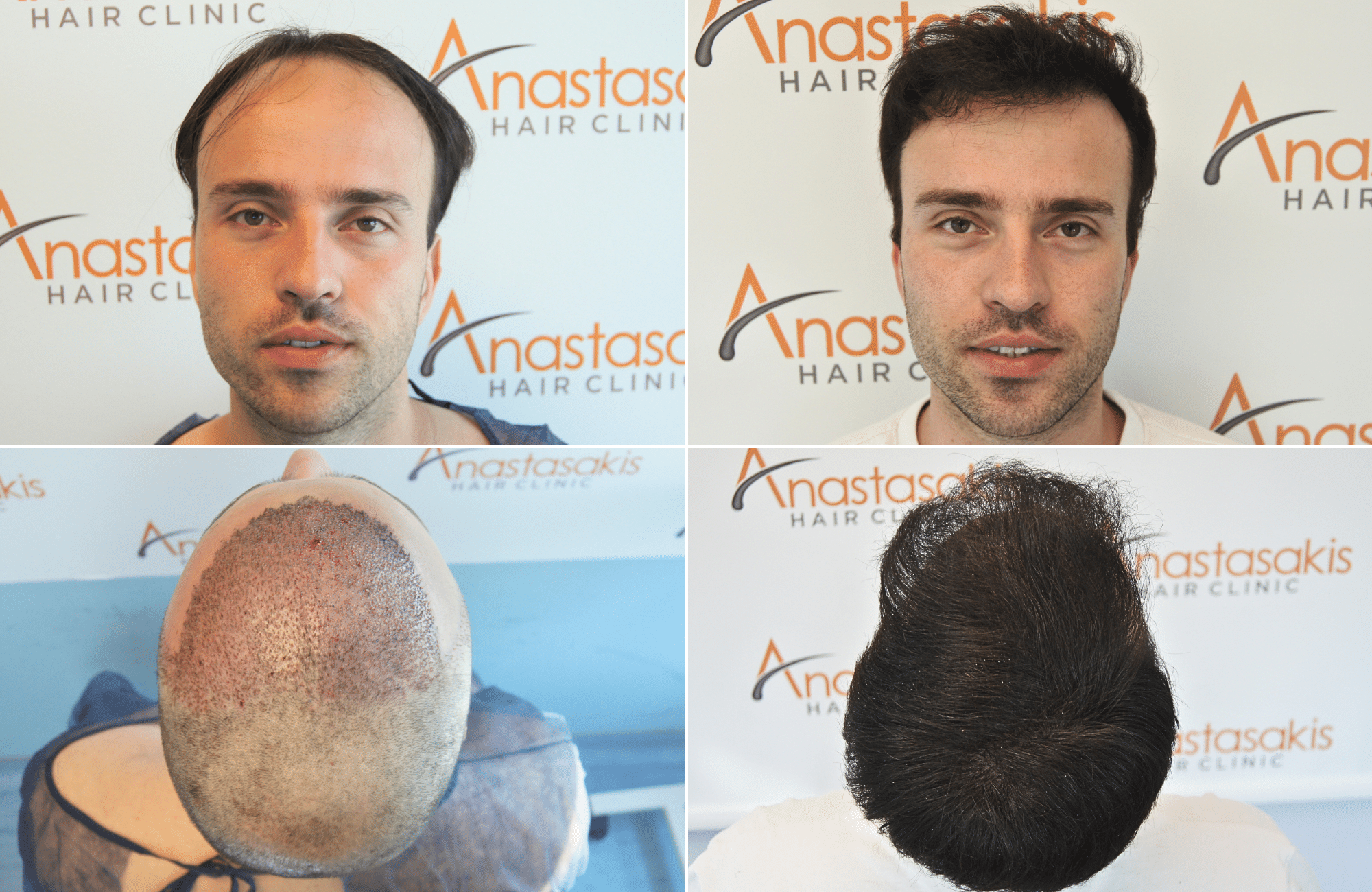 https://anastasakishairclinic.com/portfolio/apotelesma-metamosxefsis-mallion-anastasakis-hair-clinic-452/