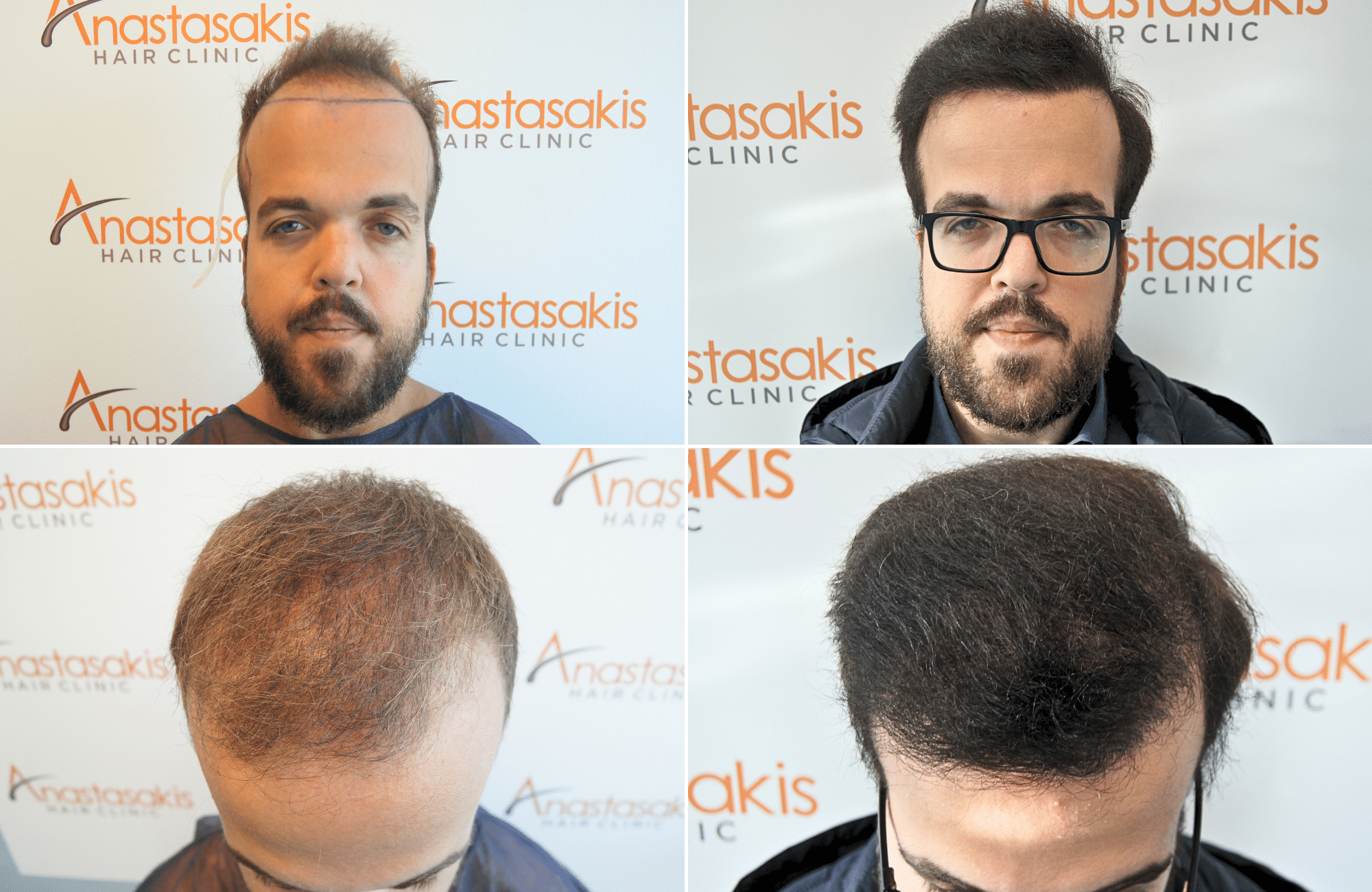 https://anastasakishairclinic.com/portfolio/apotelesma-metamosxefsis-mallion-anastasakis-hair-clinic-456/