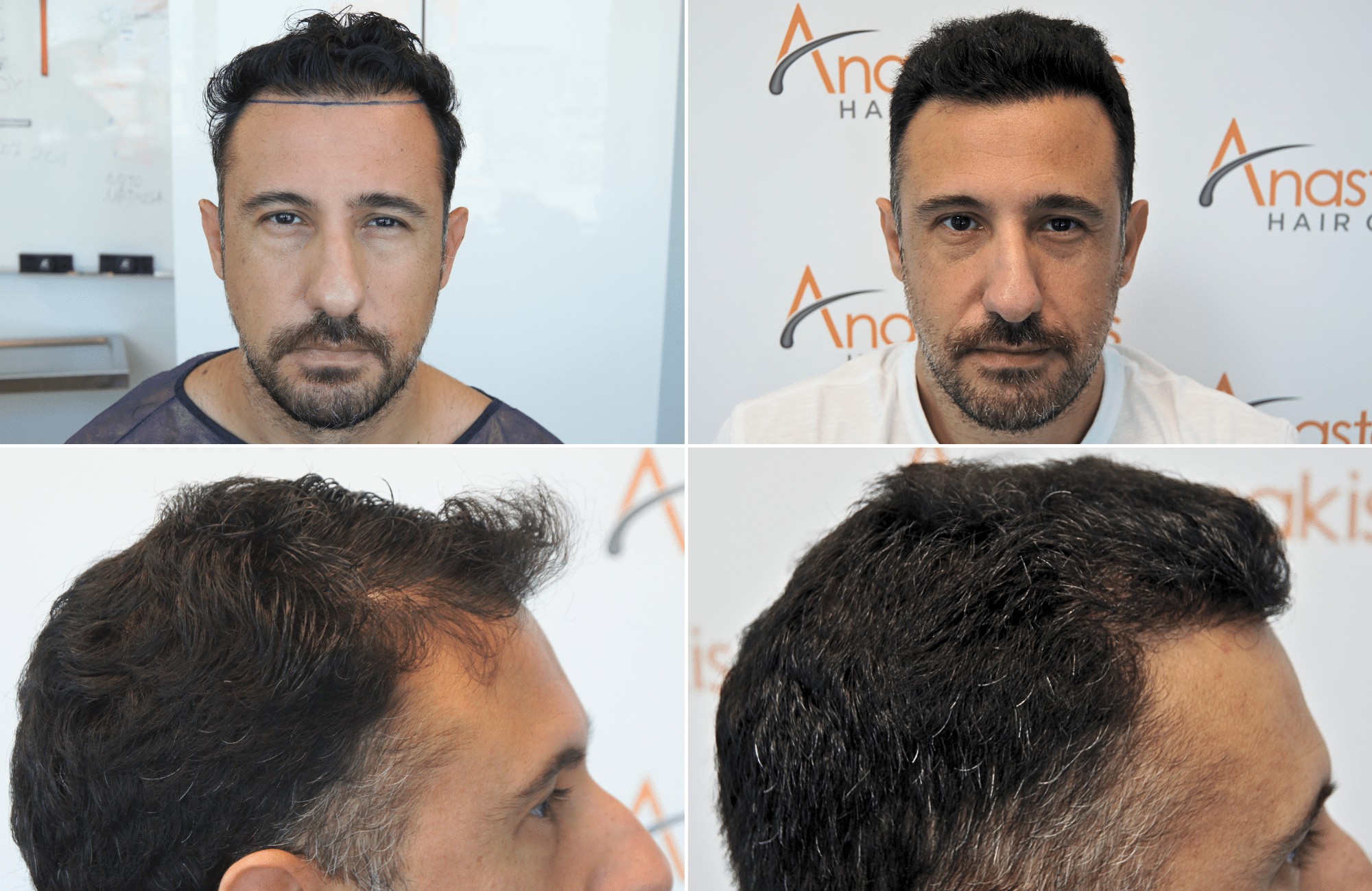 https://anastasakishairclinic.com/portfolio/apotelesma-metamosxefsis-mallion-anastasakis-hair-clinic-453/