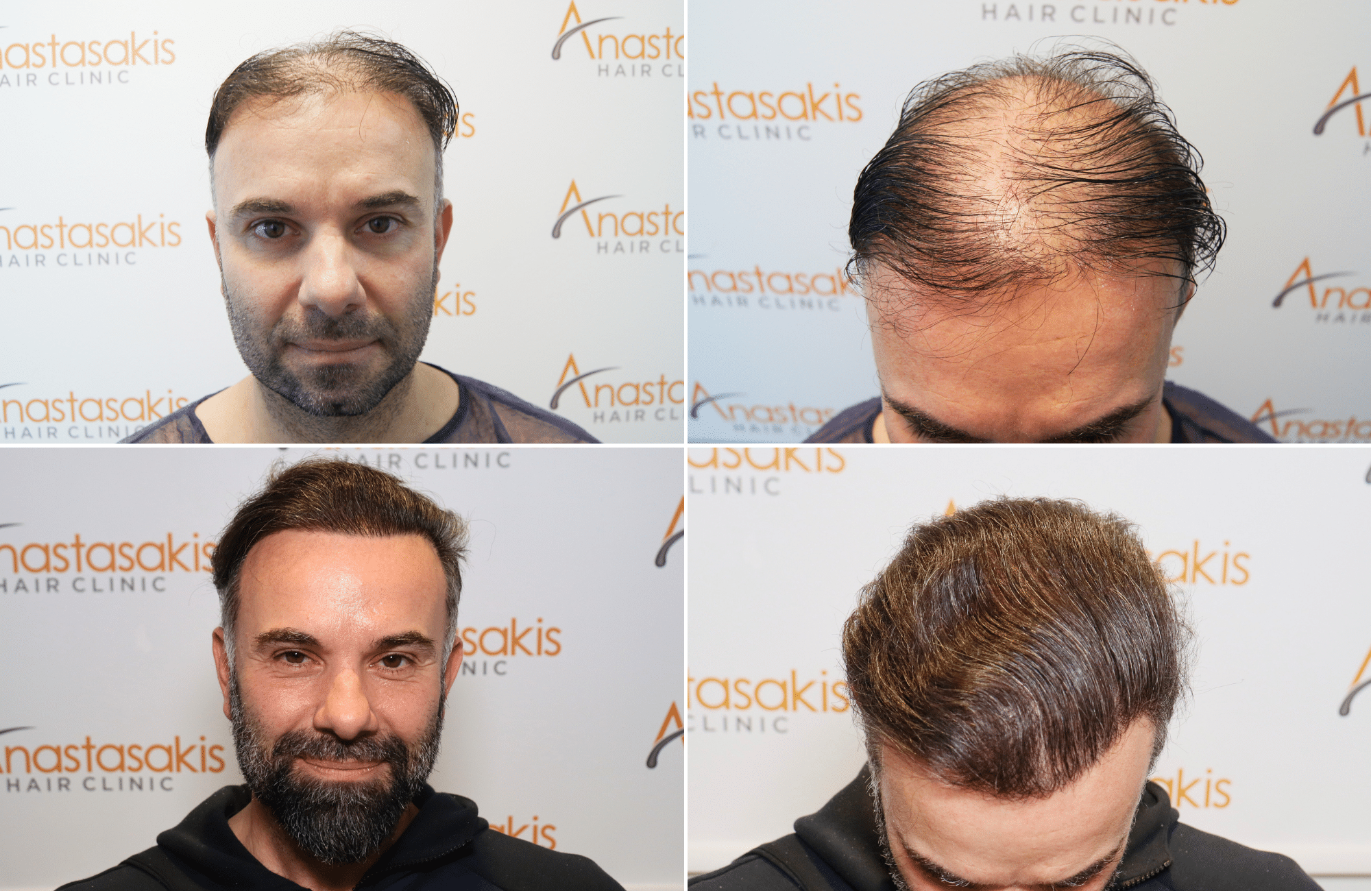 hair transplant result