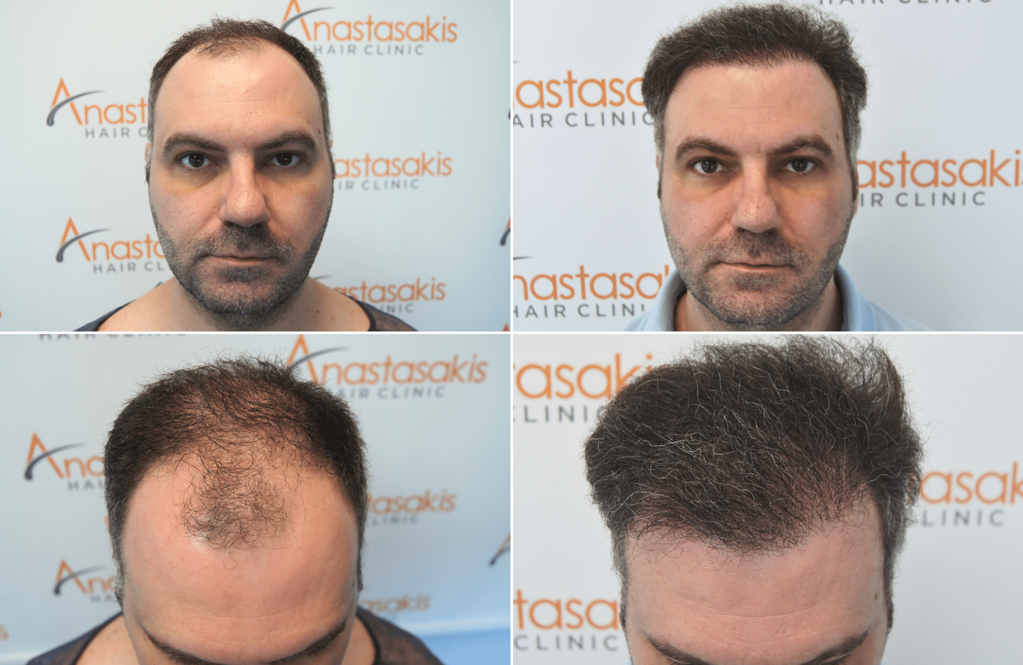 https://anastasakishairclinic.com/portfolio/apotelesma-metamosxefsis-mallion-anastasakis-hair-clinic-450/