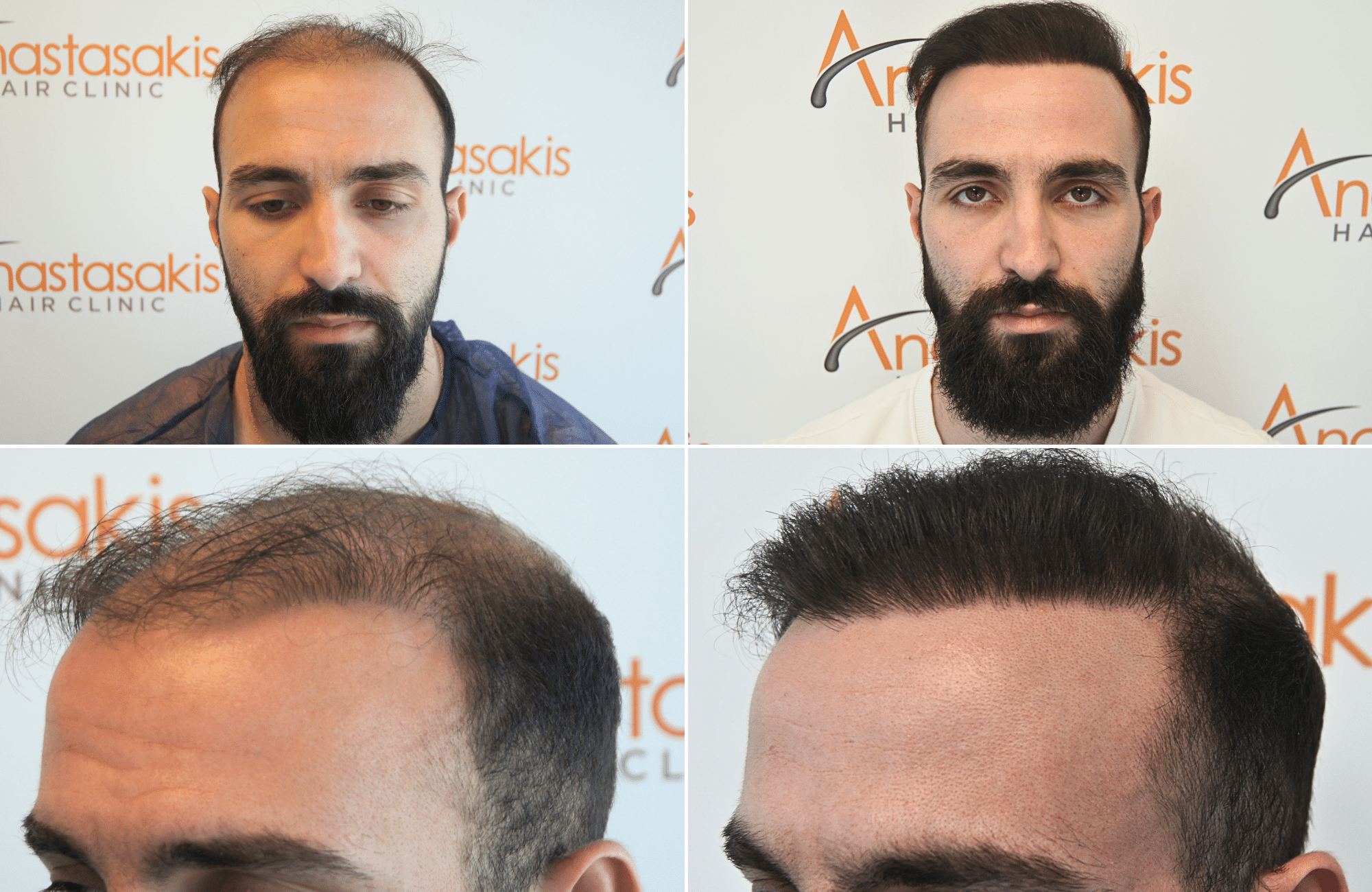 https://anastasakishairclinic.com/portfolio/apotelesma-metamosxefsis-mallion-anastasakis-hair-clinic-451/