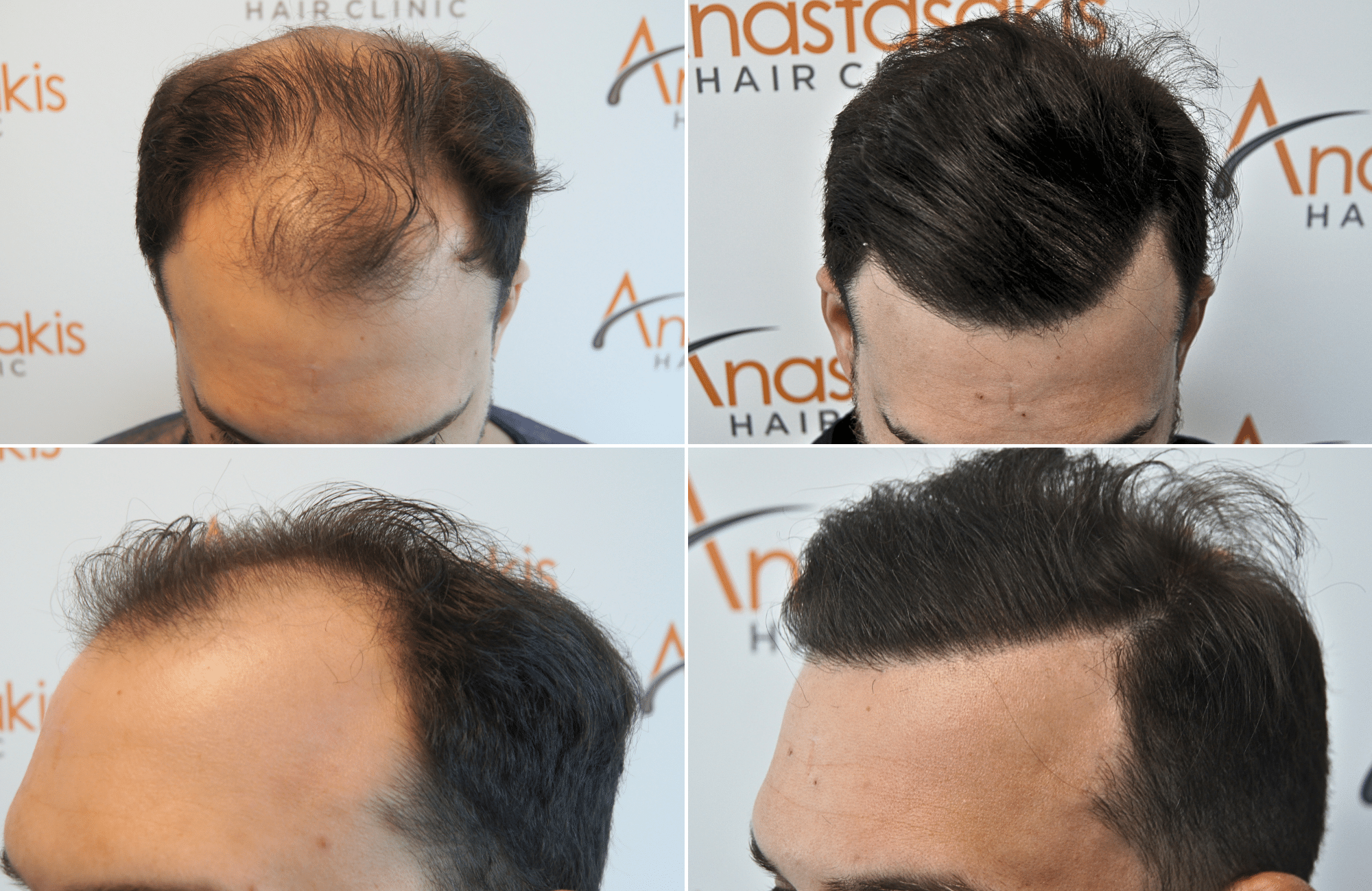 https://anastasakishairclinic.com/portfolio/apotelesma-metamosxefsis-mallion-anastasakis-hair-clinic-459/