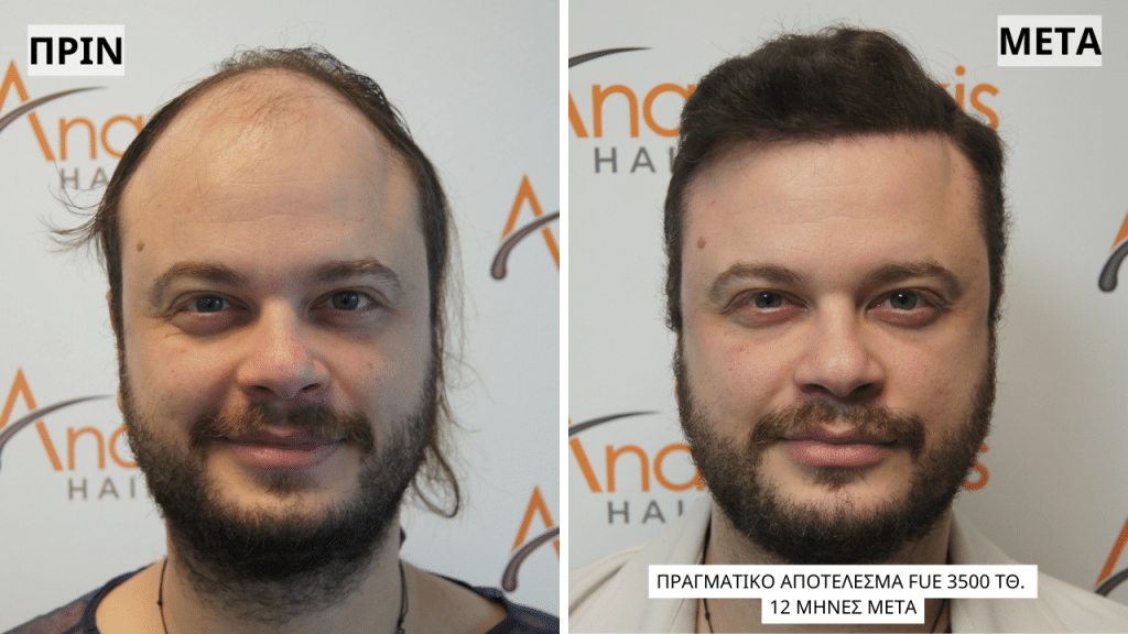 Μεταμόσχευση Μαλλιών και AI - Πριν το ai tool και μετά