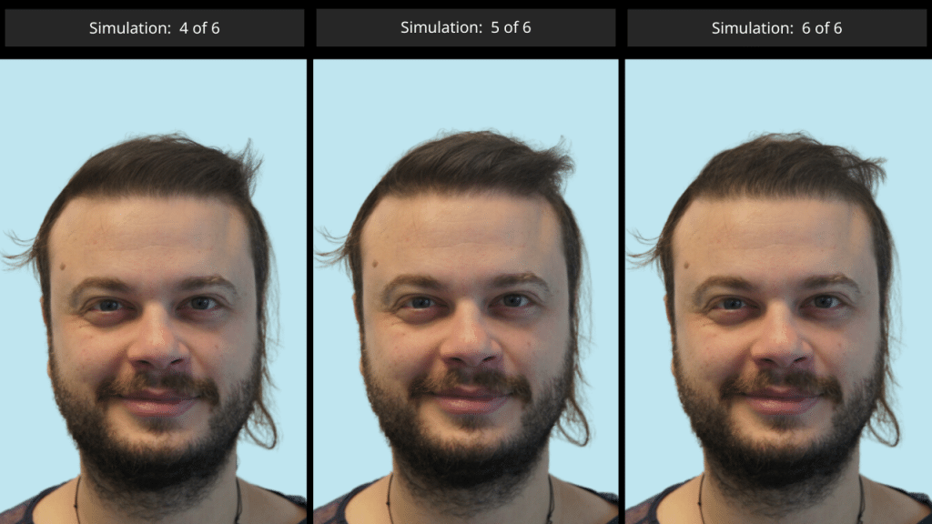 AI Simulation Tool για Μεταμόσχευση Μαλλιών