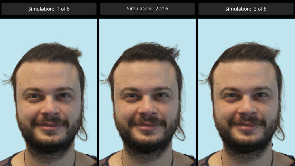 AI Simulation Tool - Μεταμόσχευση Μαλλιών