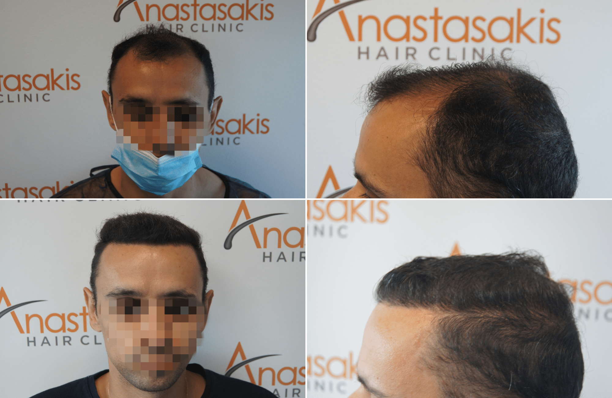 https://anastasakishairclinic.com/portfolio/apotelesma-metamosxefsis-mallion-anastasakis-hair-clinic-464/