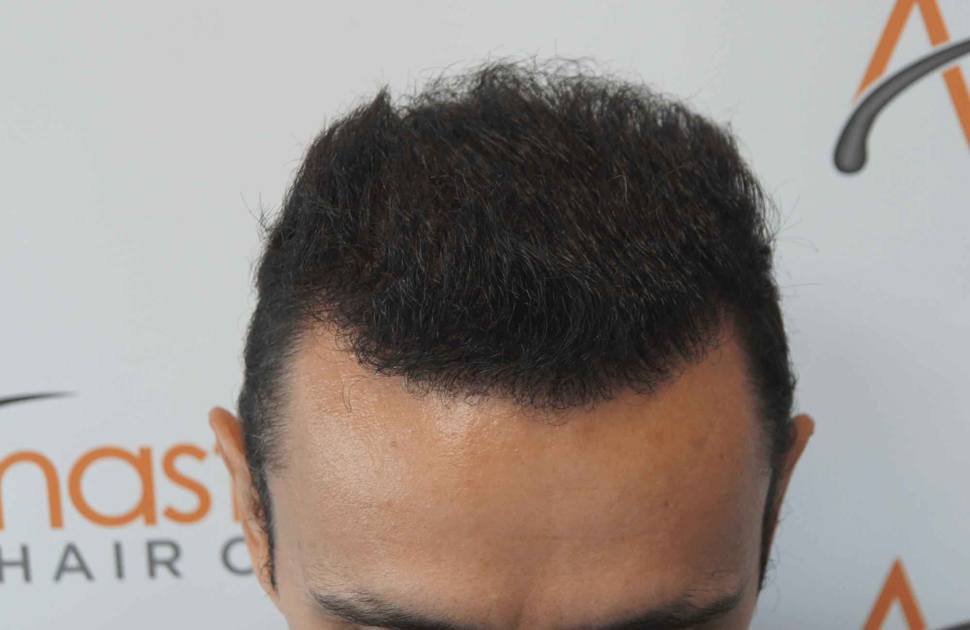 after hair transplant with 2500 fus in anastasakis hair clinic frontal