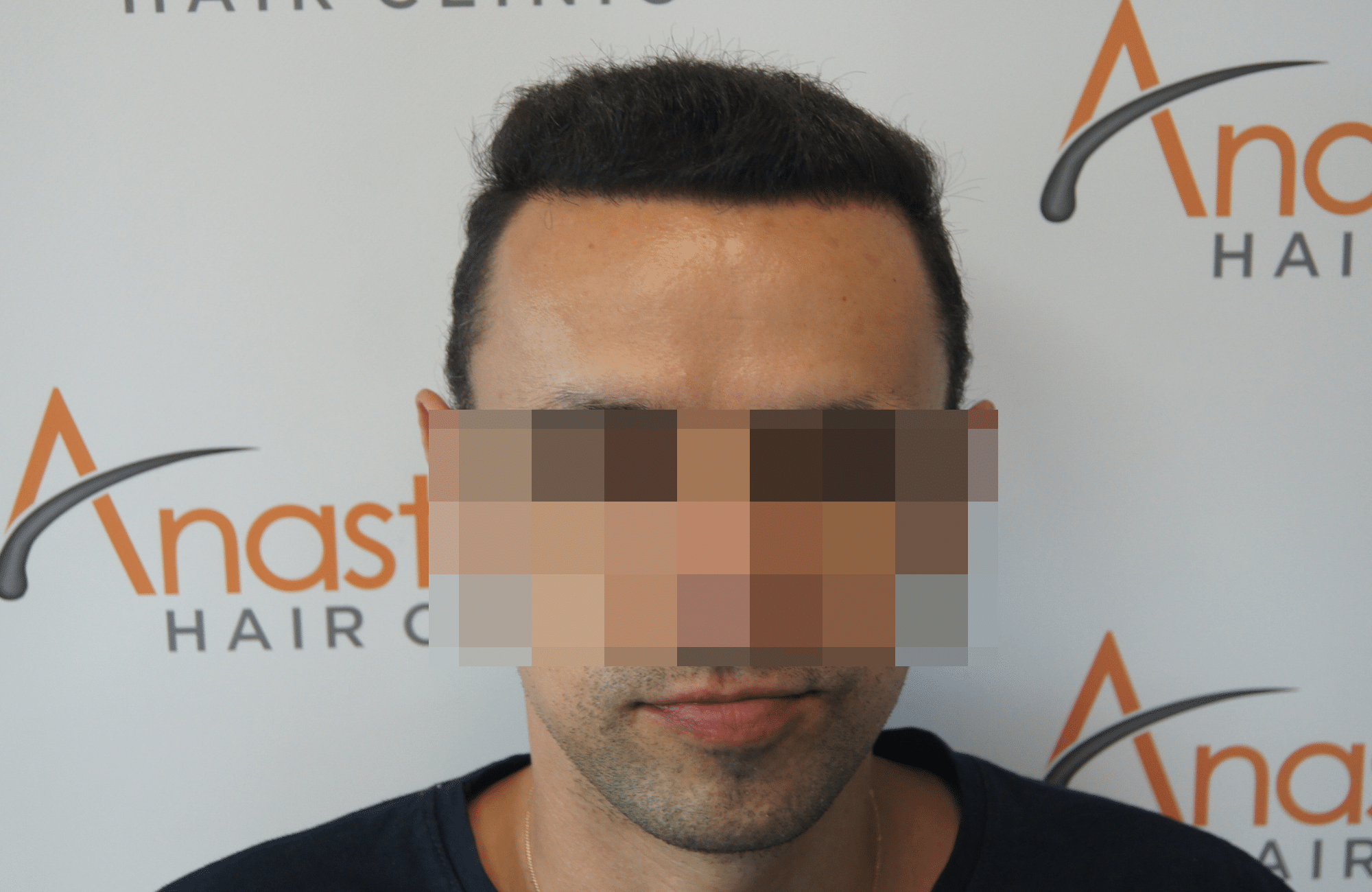 after hair transplant with 2500 fus in anastasakis hair clinic fullface_anonymized