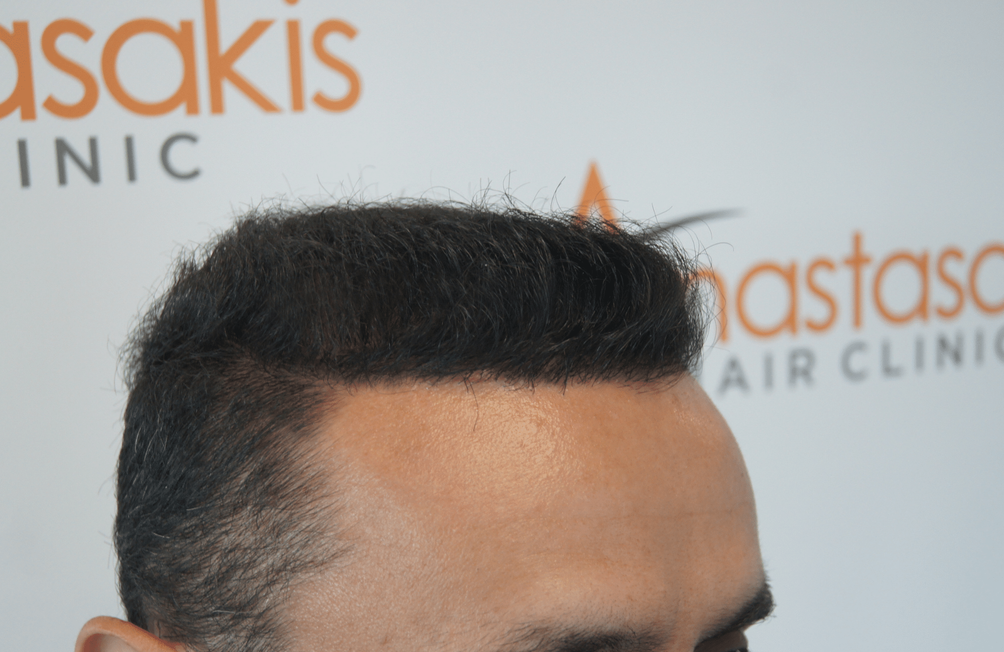 after hair transplant with 2500 fus in anastasakis hair clinic side1