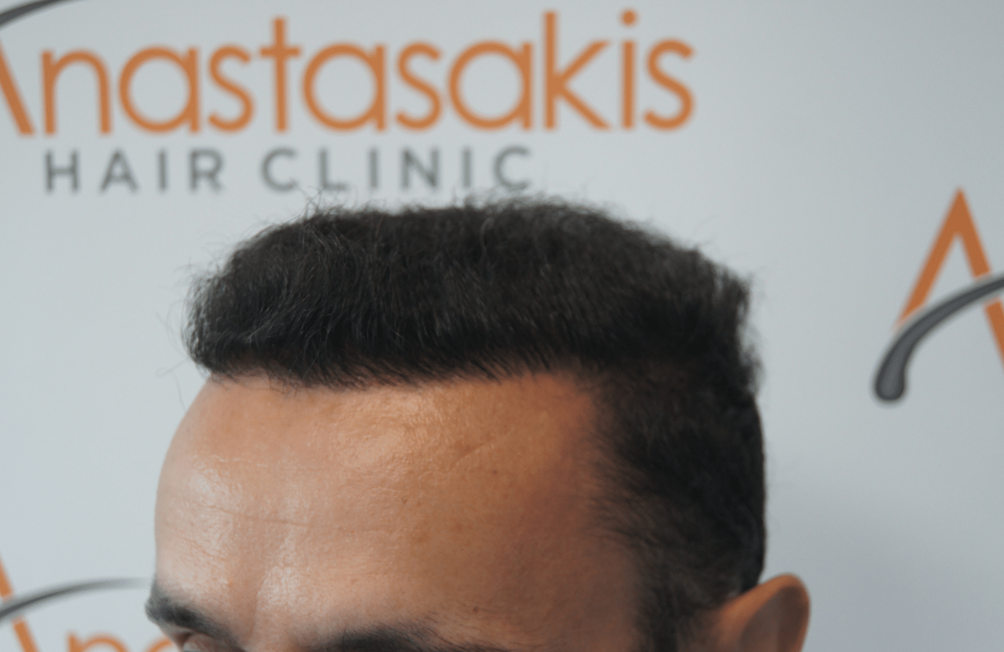 after hair transplant with 2500 fus in anastasakis hair clinic side2