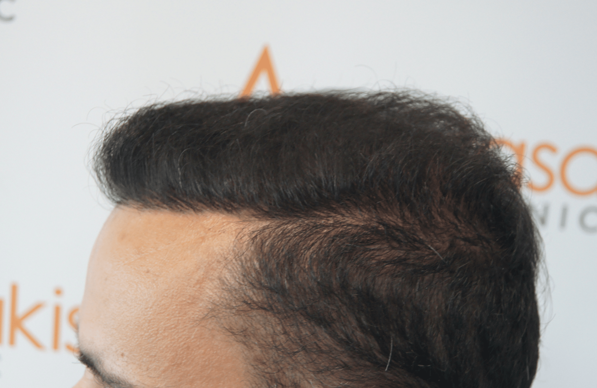 after hair transplant with 2500 fus in anastasakis hair clinic side3