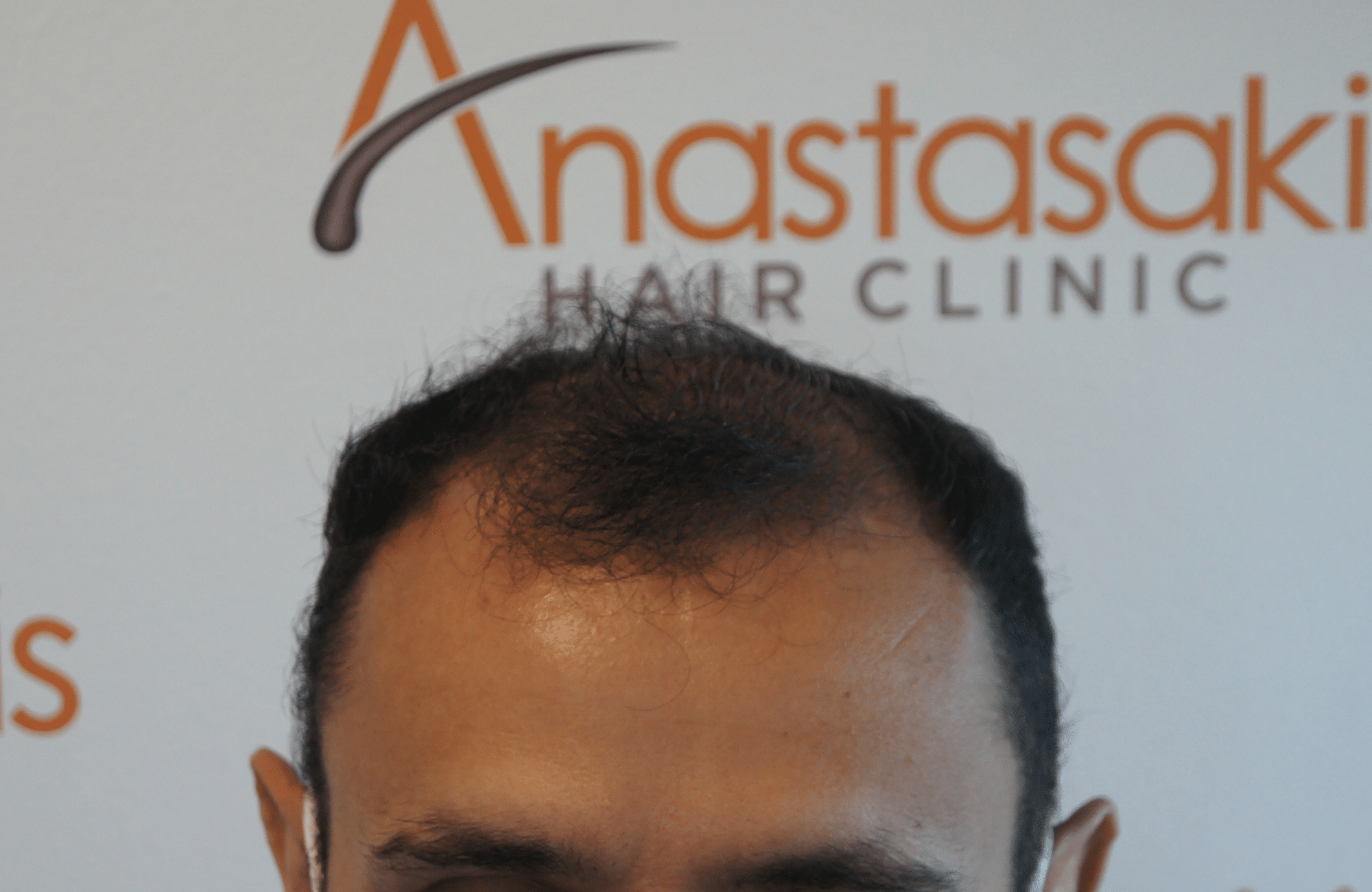 before hair transplant in anastasakis hair clinic hairline