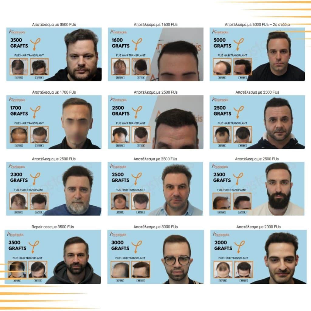 Φυσικη Vs μη φυσική μεταμόσχευση μαλλιών- αποτελέσματα πετυχημένης μεταμόσχευσης