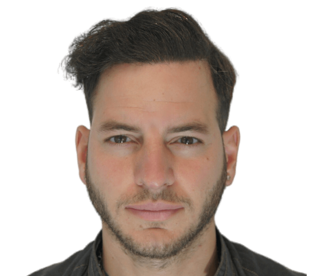 Hair Transplant