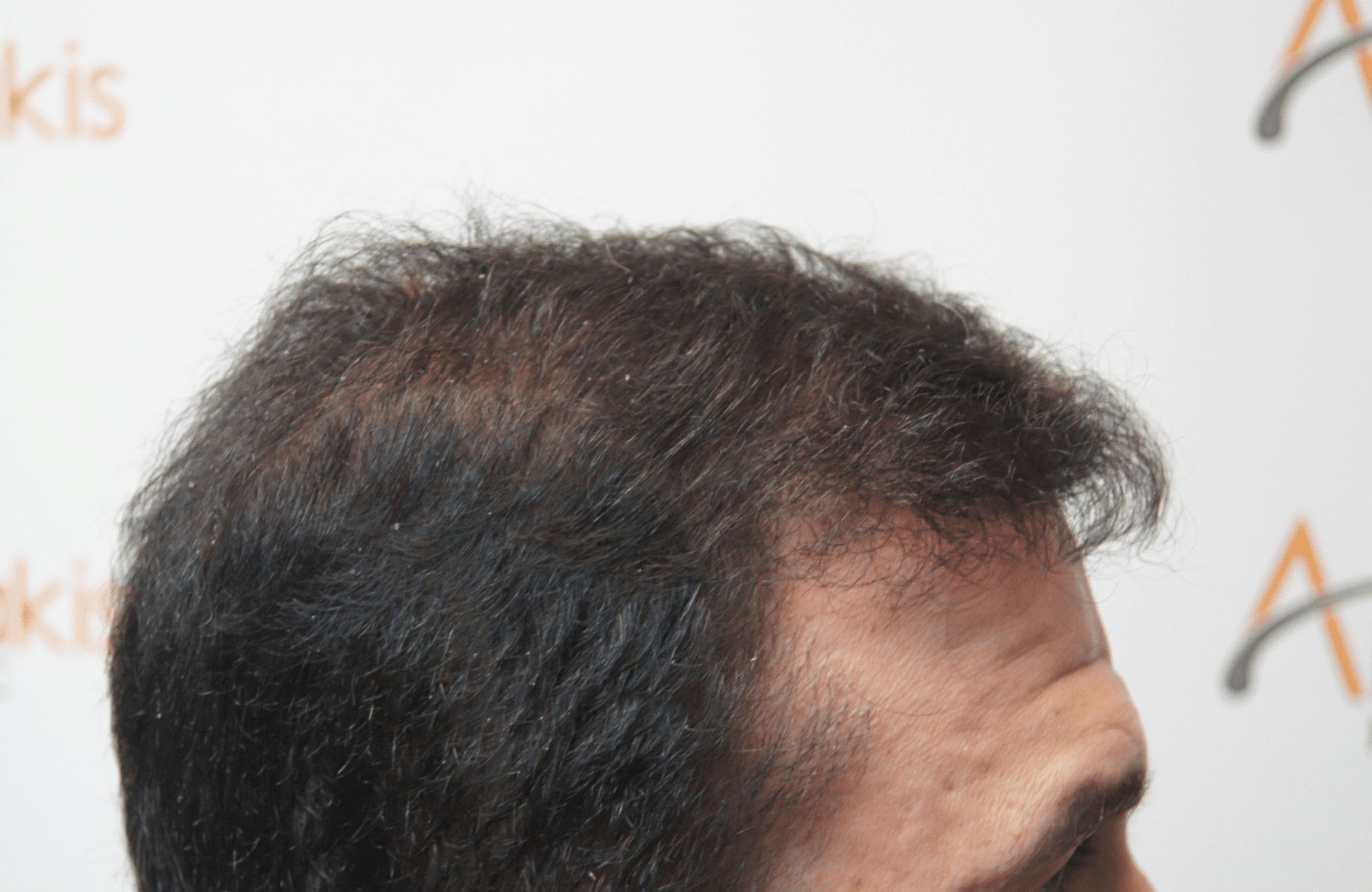 hair transplant result with 3000 follicular units anastasakis hair clinic