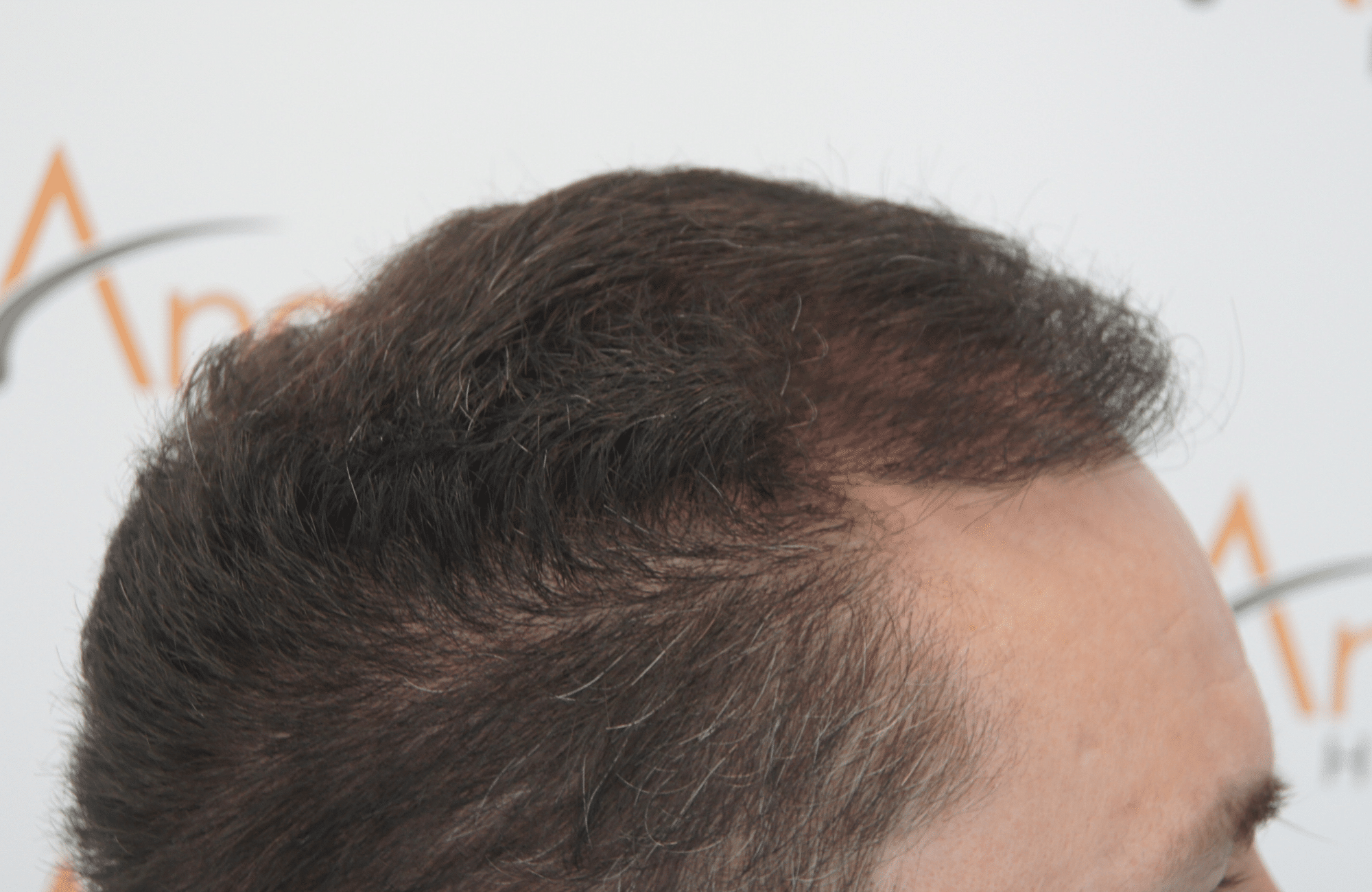 hair transplant result with 2500 follicular units anastasakis hair clinic