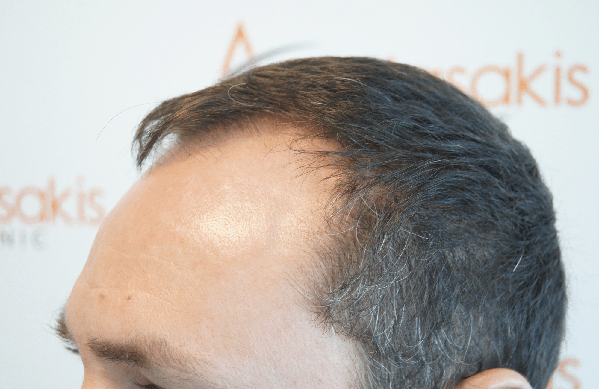 hair transplant result with 2500 follicular units anastasakis hair clinic