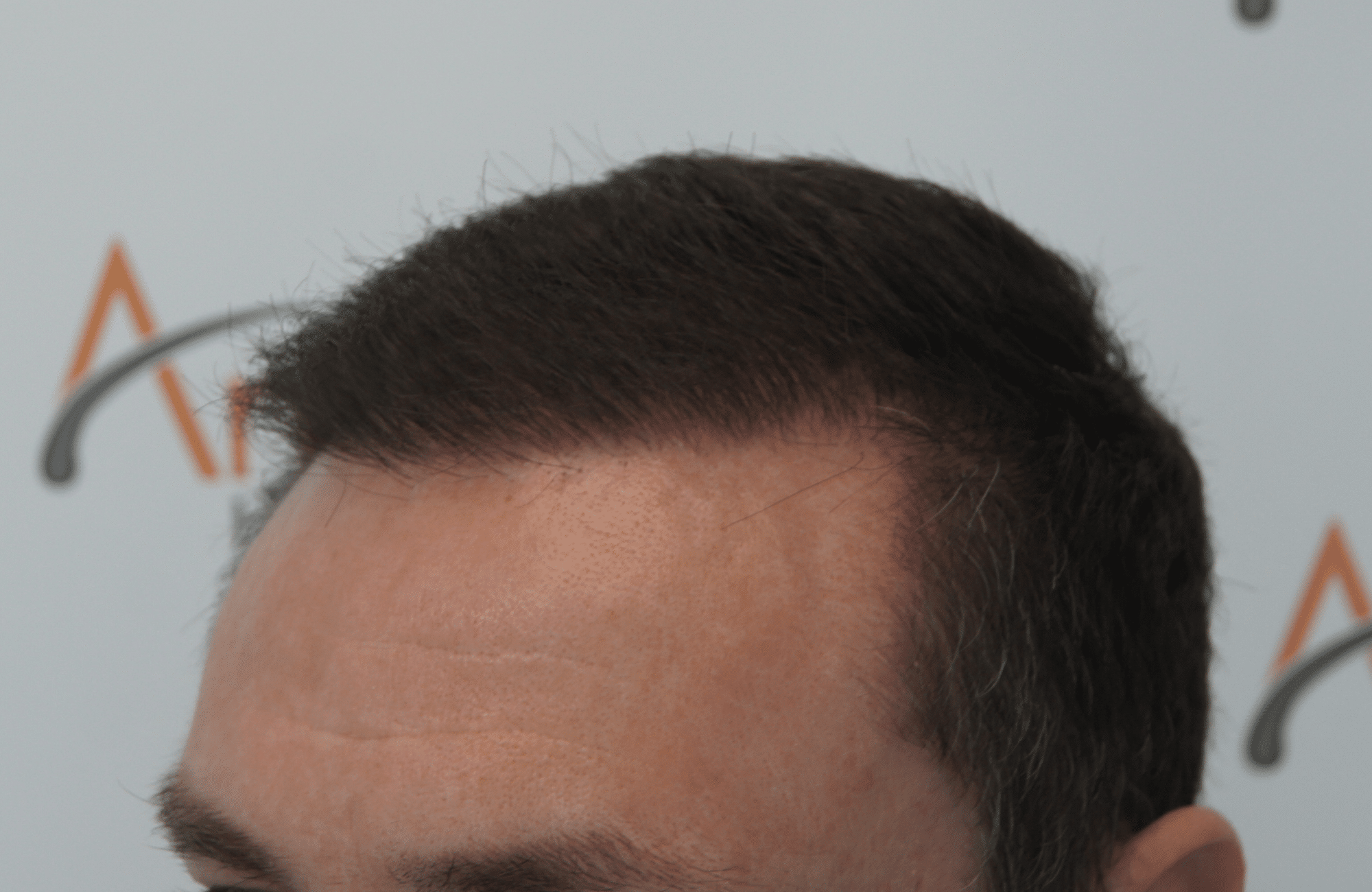 hair transplant result with 2500 follicular units anastasakis hair clinic