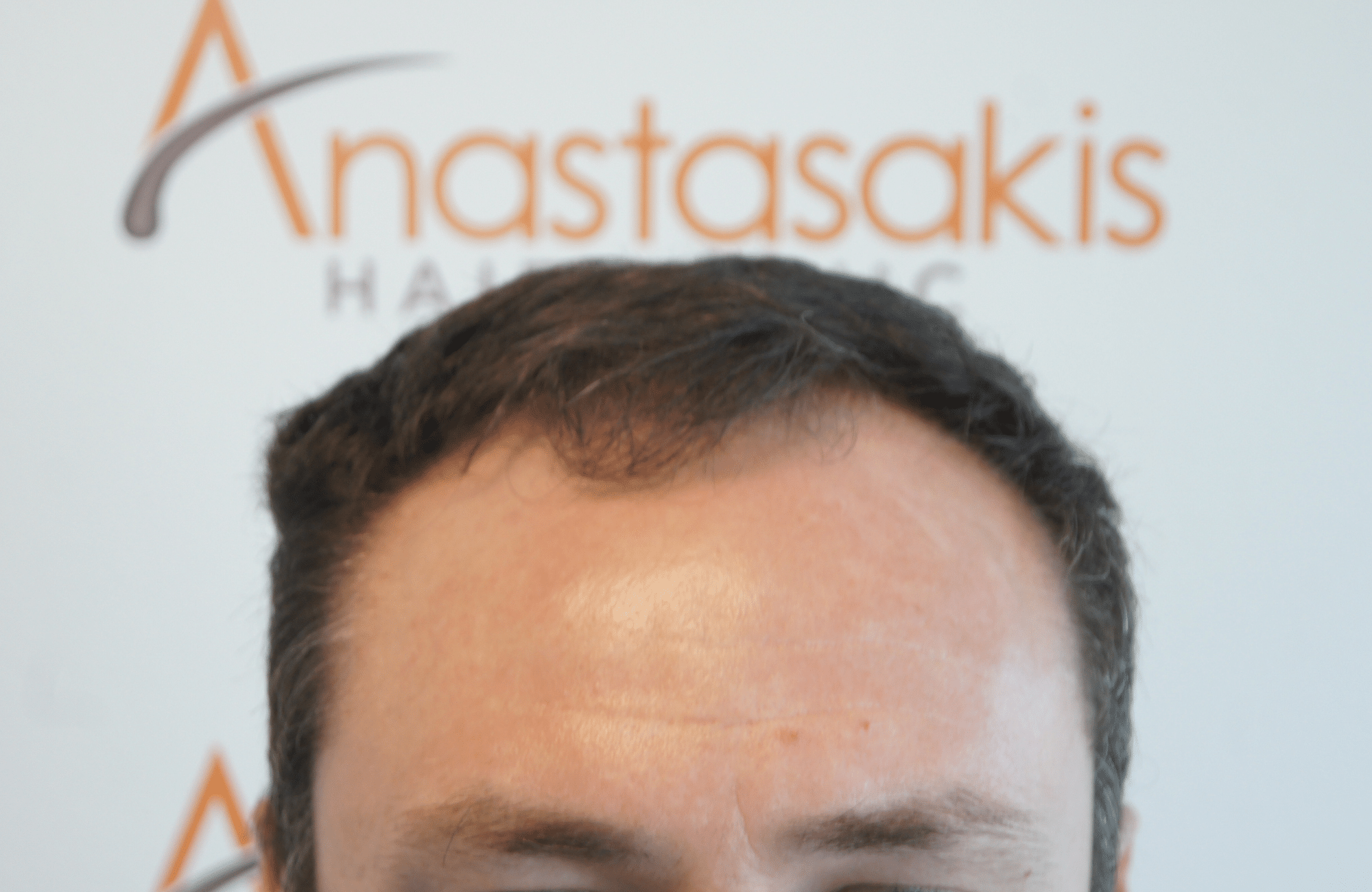 hair transplant result with 2500 follicular units anastasakis hair clinic