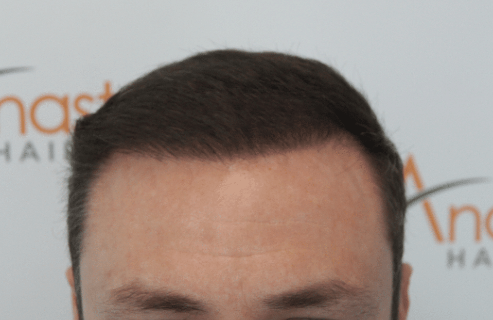 hair transplant result with 2500 follicular units anastasakis hair clinic