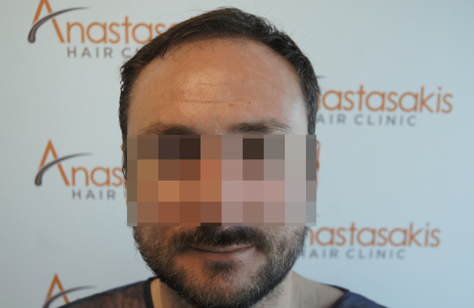 hair transplant result with 2500 follicular units anastasakis hair clinic
