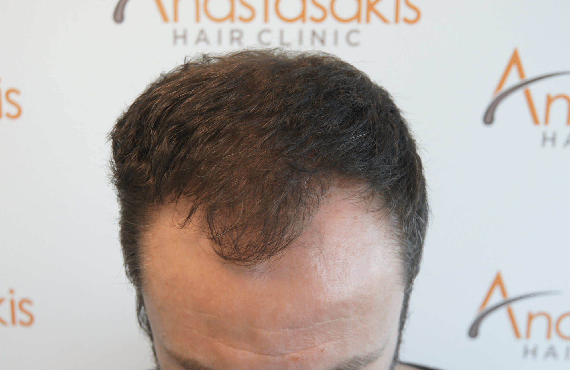 hair transplant result with 2500 follicular units anastasakis hair clinic