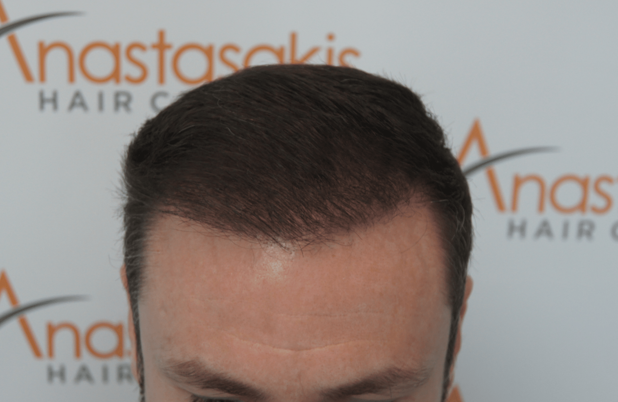 hair transplant result with 2500 follicular units anastasakis hair clinic