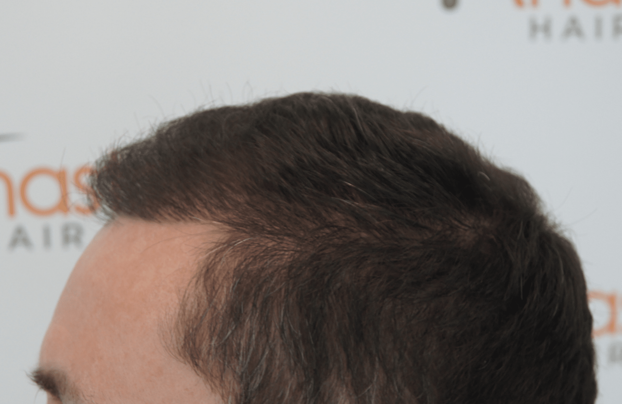 hair transplant result with 2500 follicular units anastasakis hair clinic