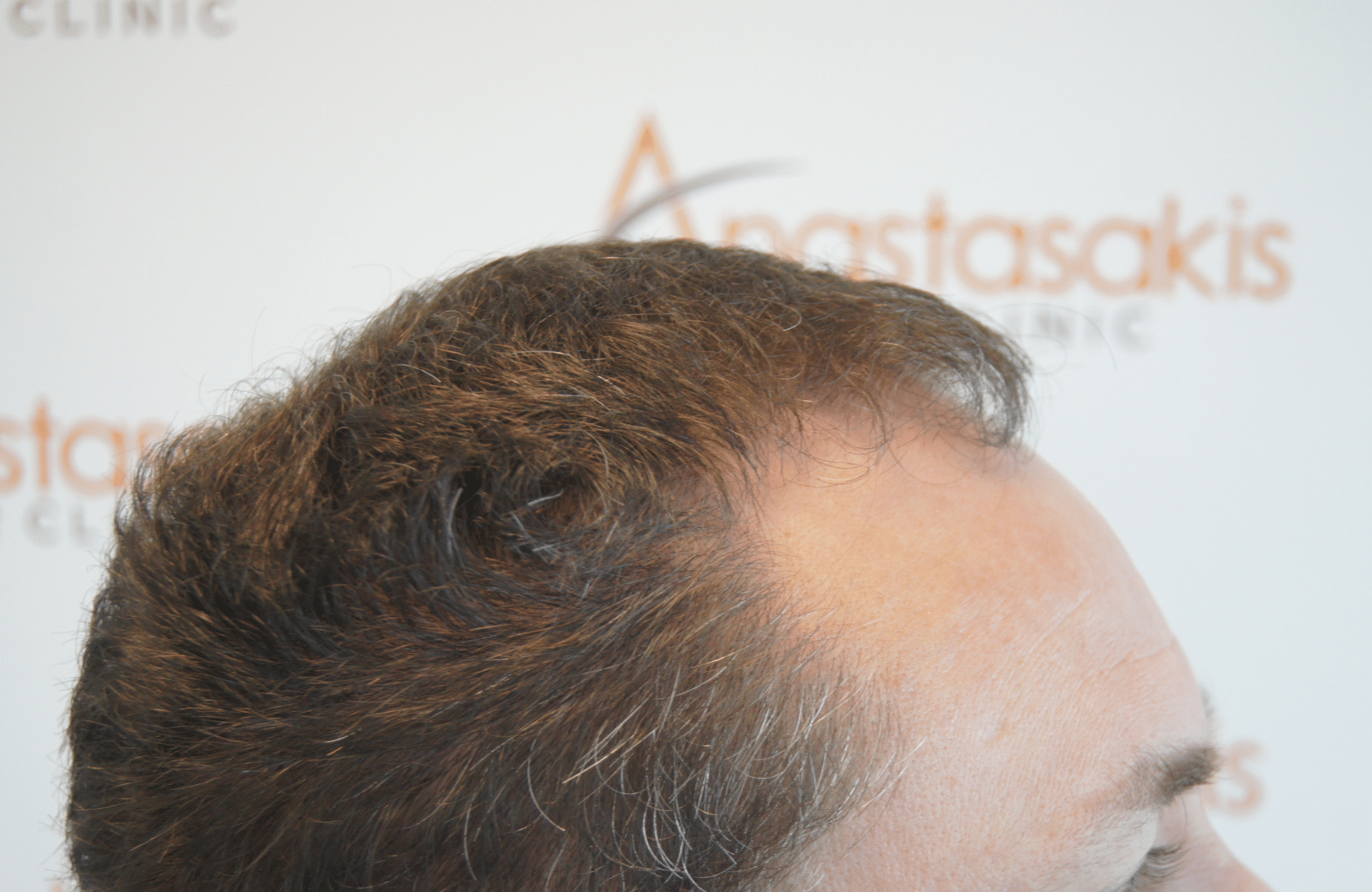 hair transplant result with 2500 follicular units anastasakis hair clinic