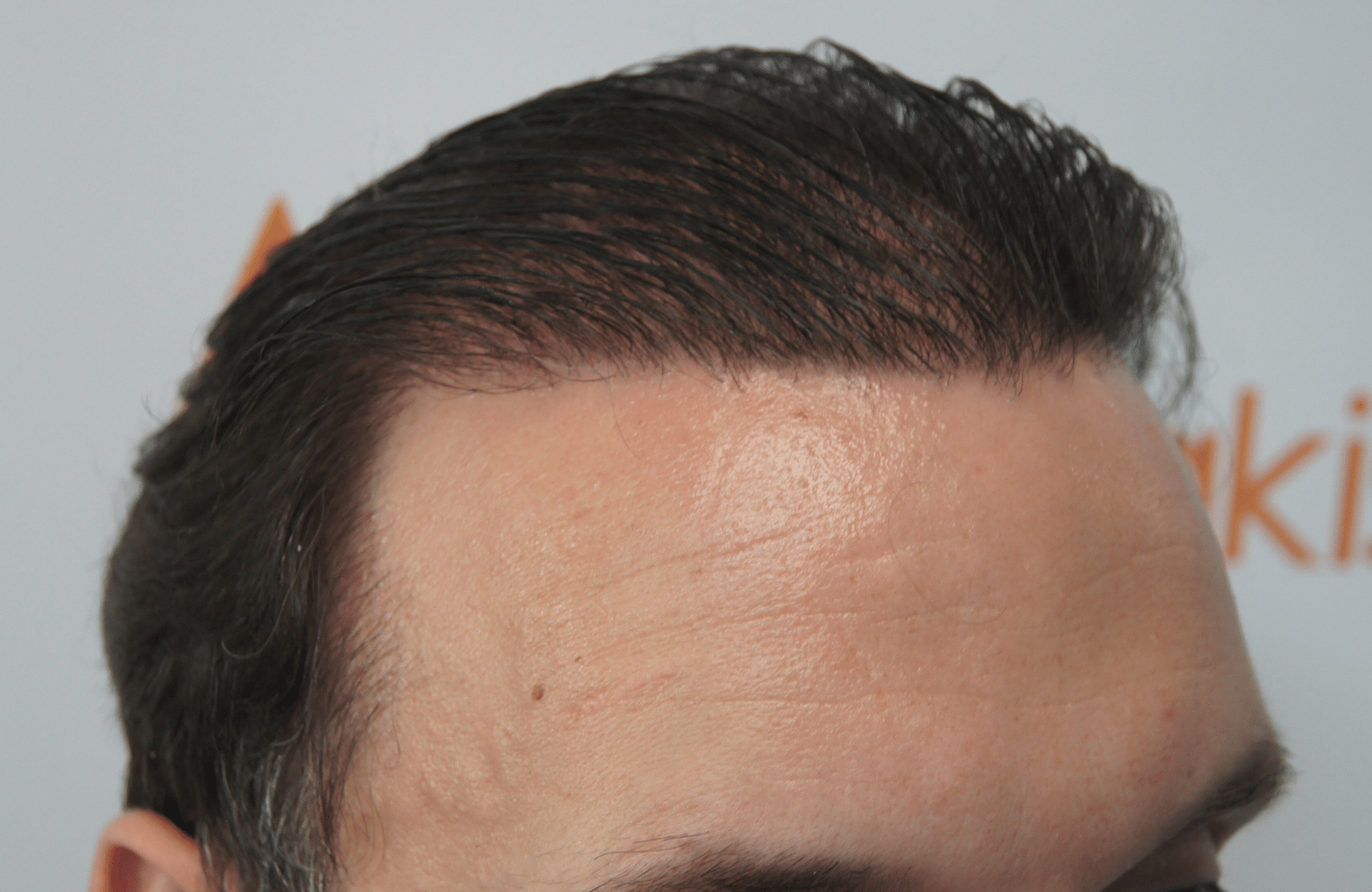 hair transplant result with 3500 follicular units anastasakis hair clinic