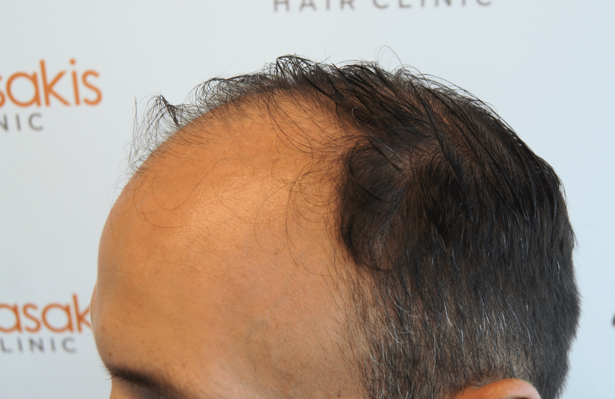 hair transplant result with 3500 follicular units anastasakis hair clinic