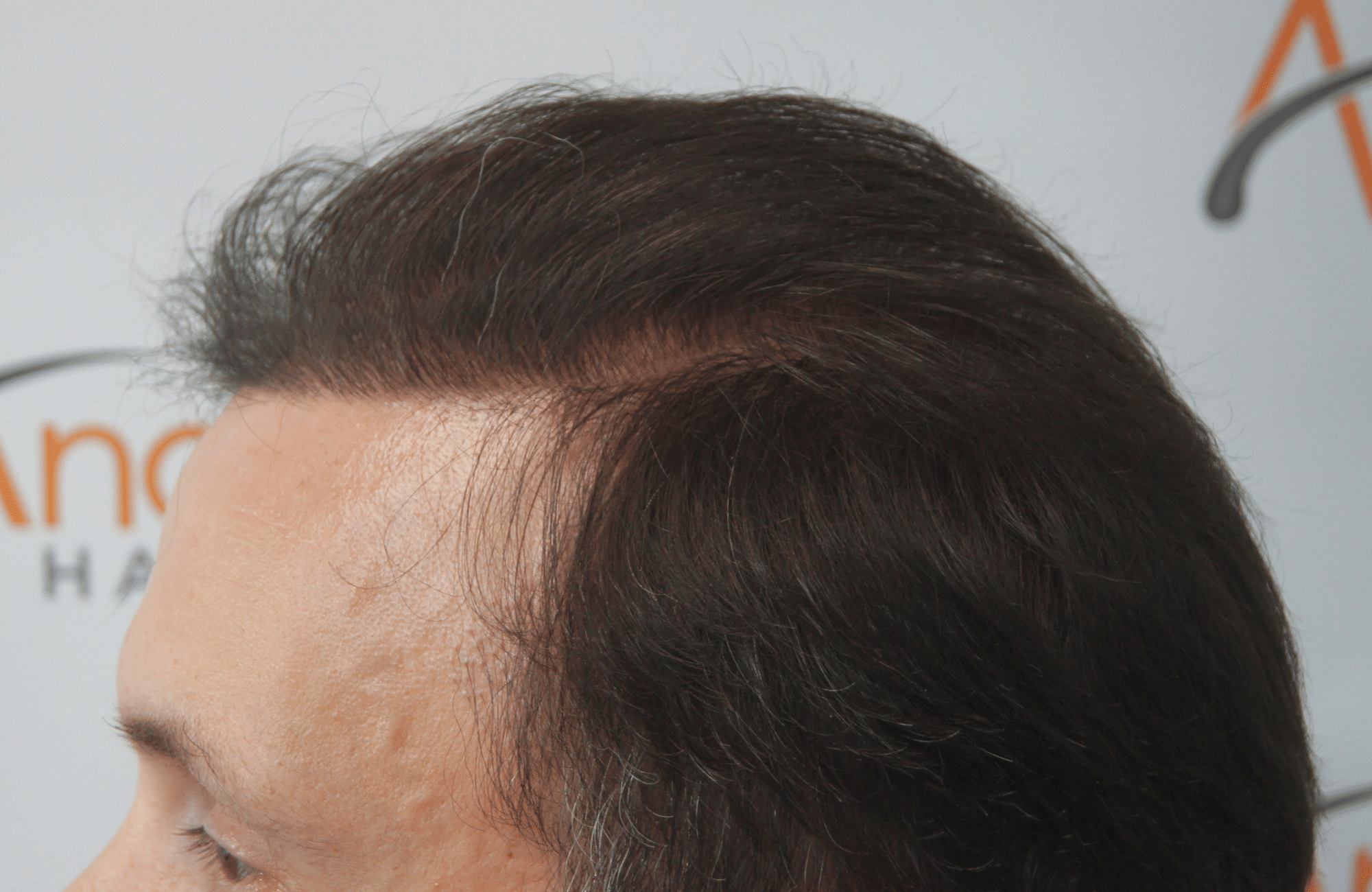 hair transplant result with 3500 follicular units anastasakis hair clinic