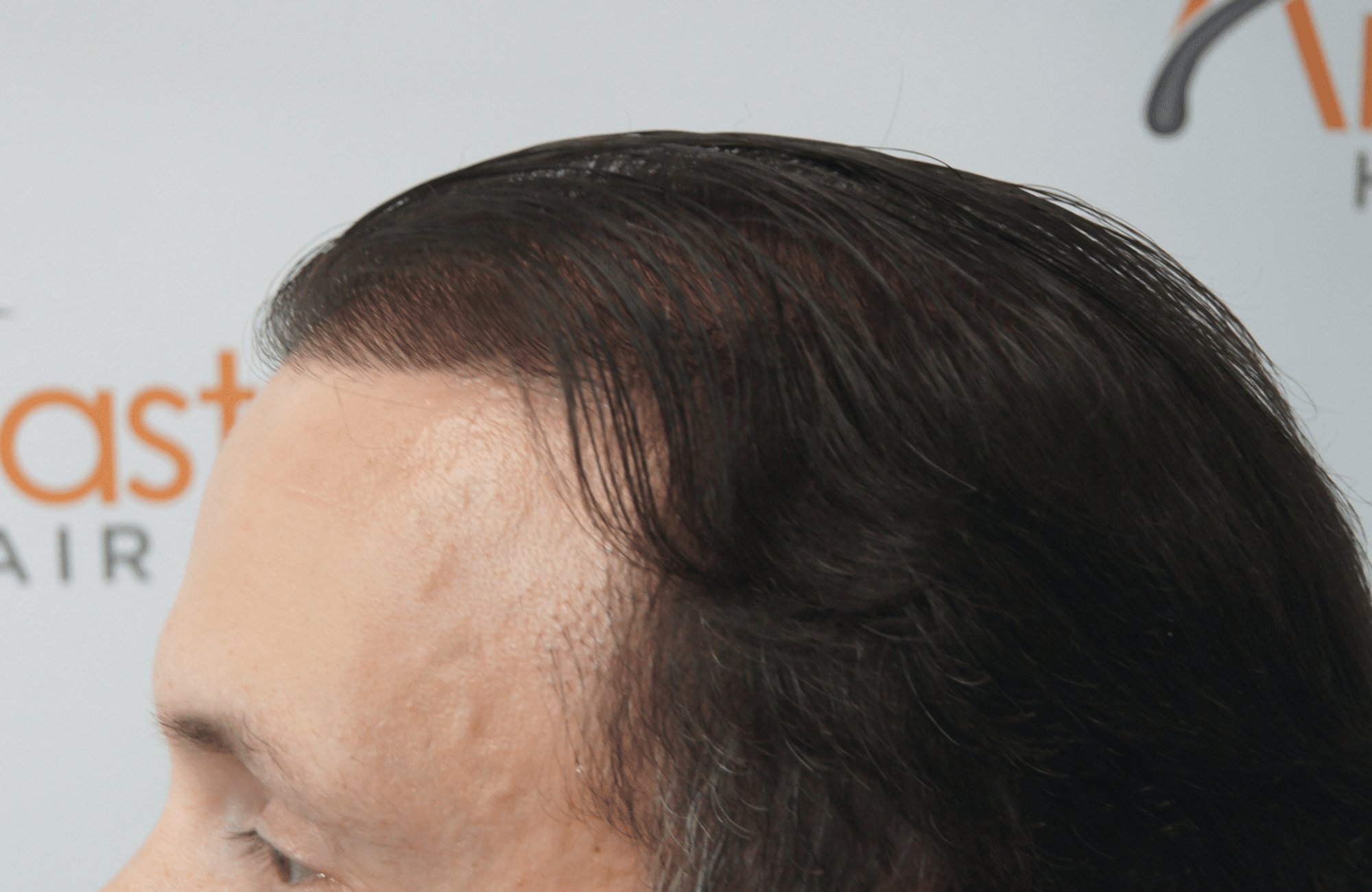 hair transplant result with 3500 follicular units anastasakis hair clinic