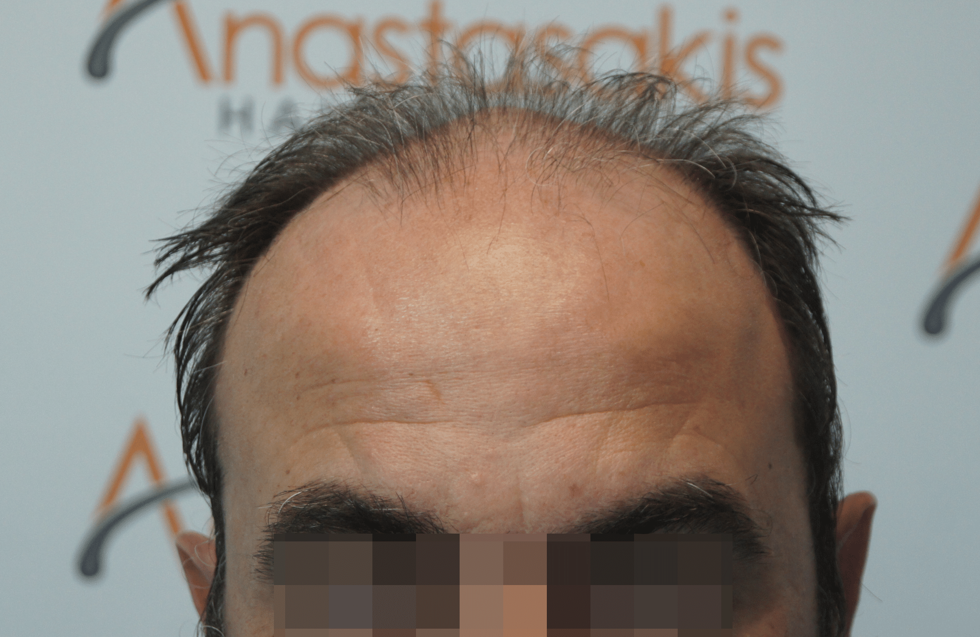 hair transplant result with 3500 follicular units anastasakis hair clinic