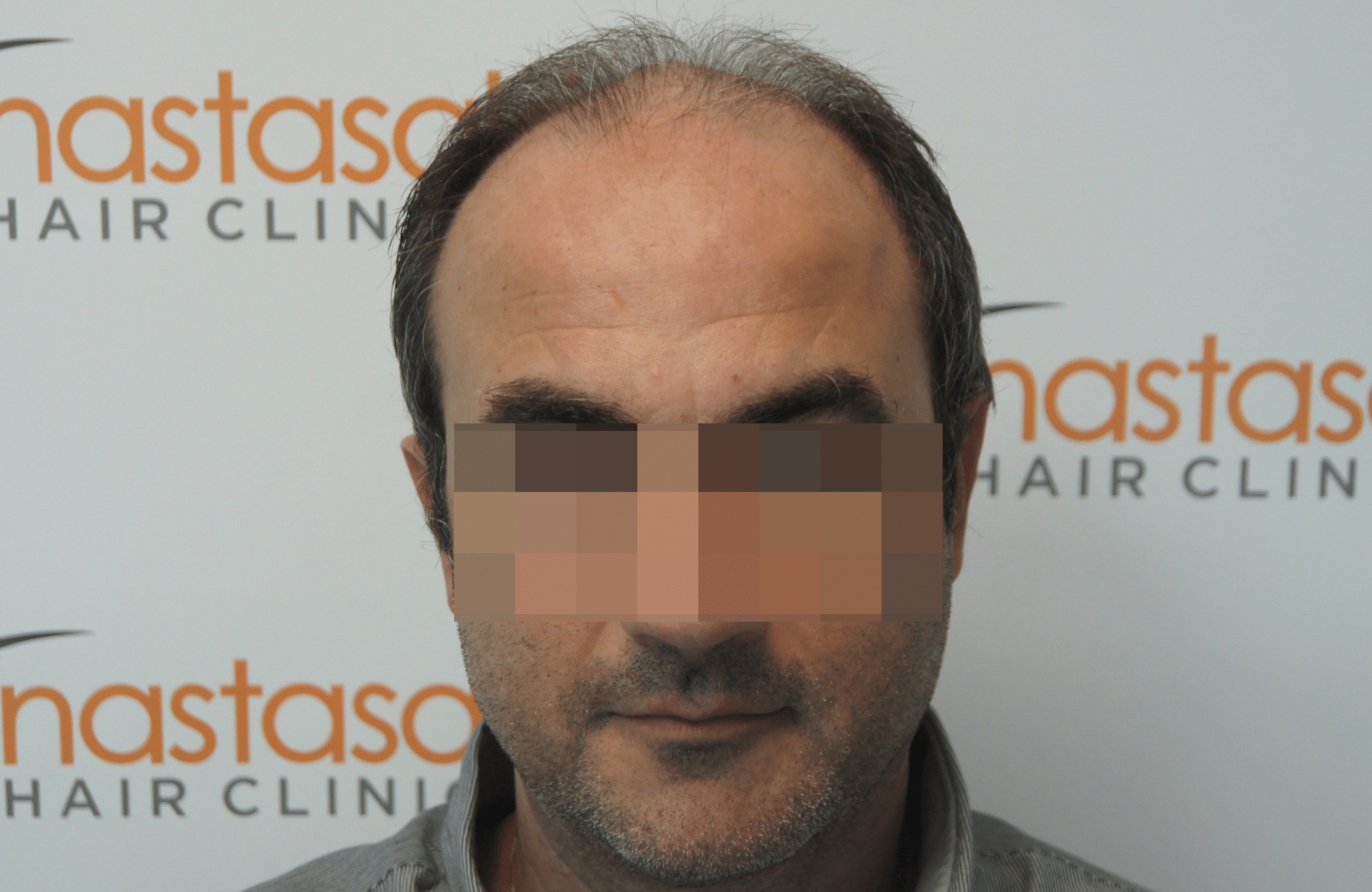 hair transplant result with 3500 follicular units anastasakis hair clinic