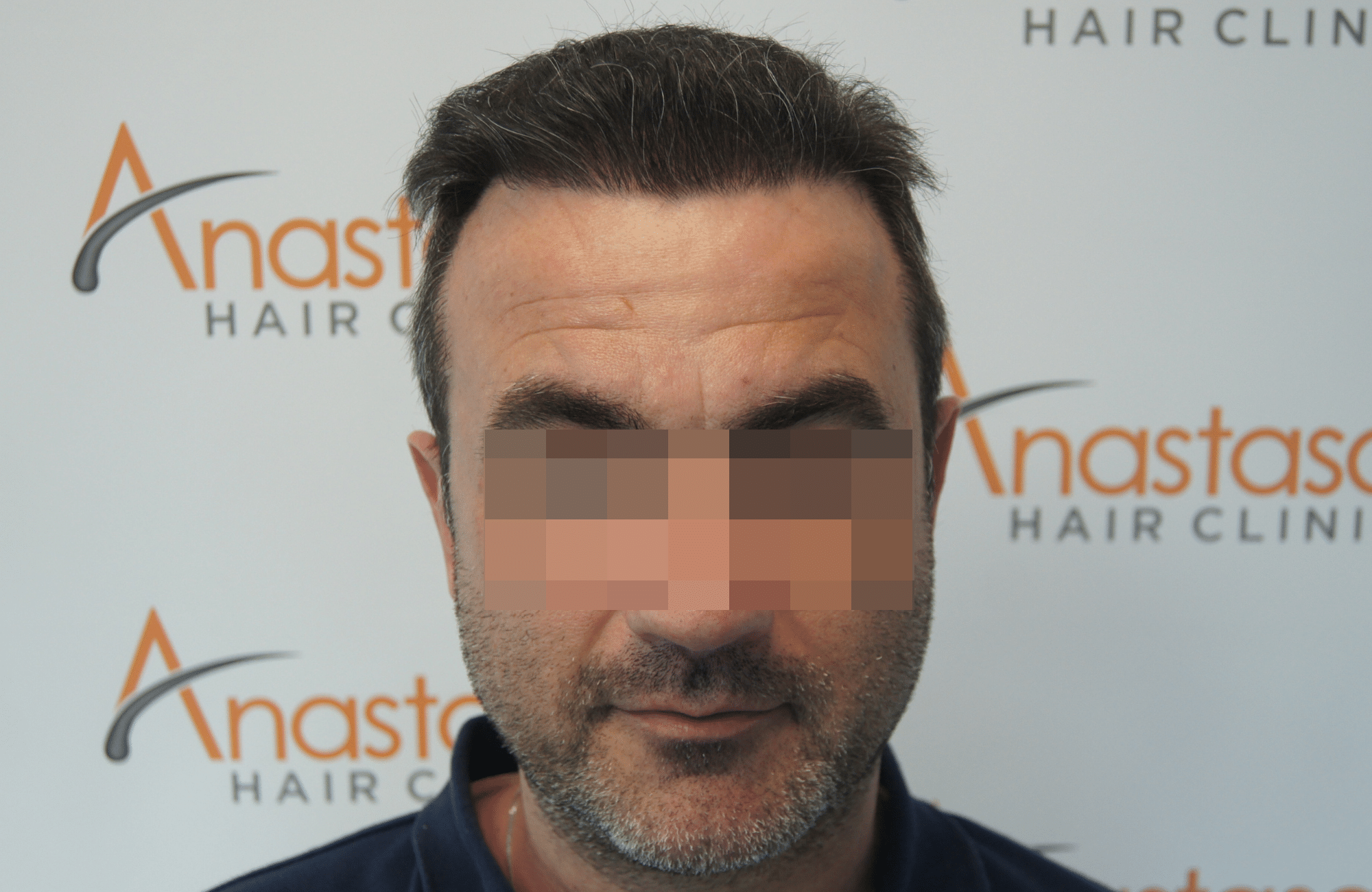 hair transplant result with 3500 follicular units anastasakis hair clinic