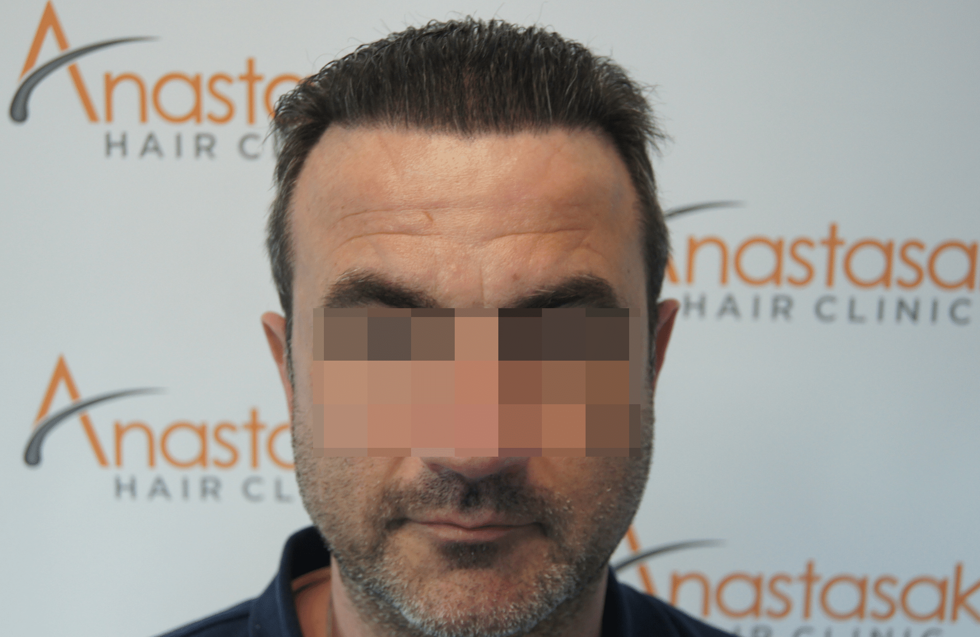 hair transplant result with 3500 follicular units anastasakis hair clinic