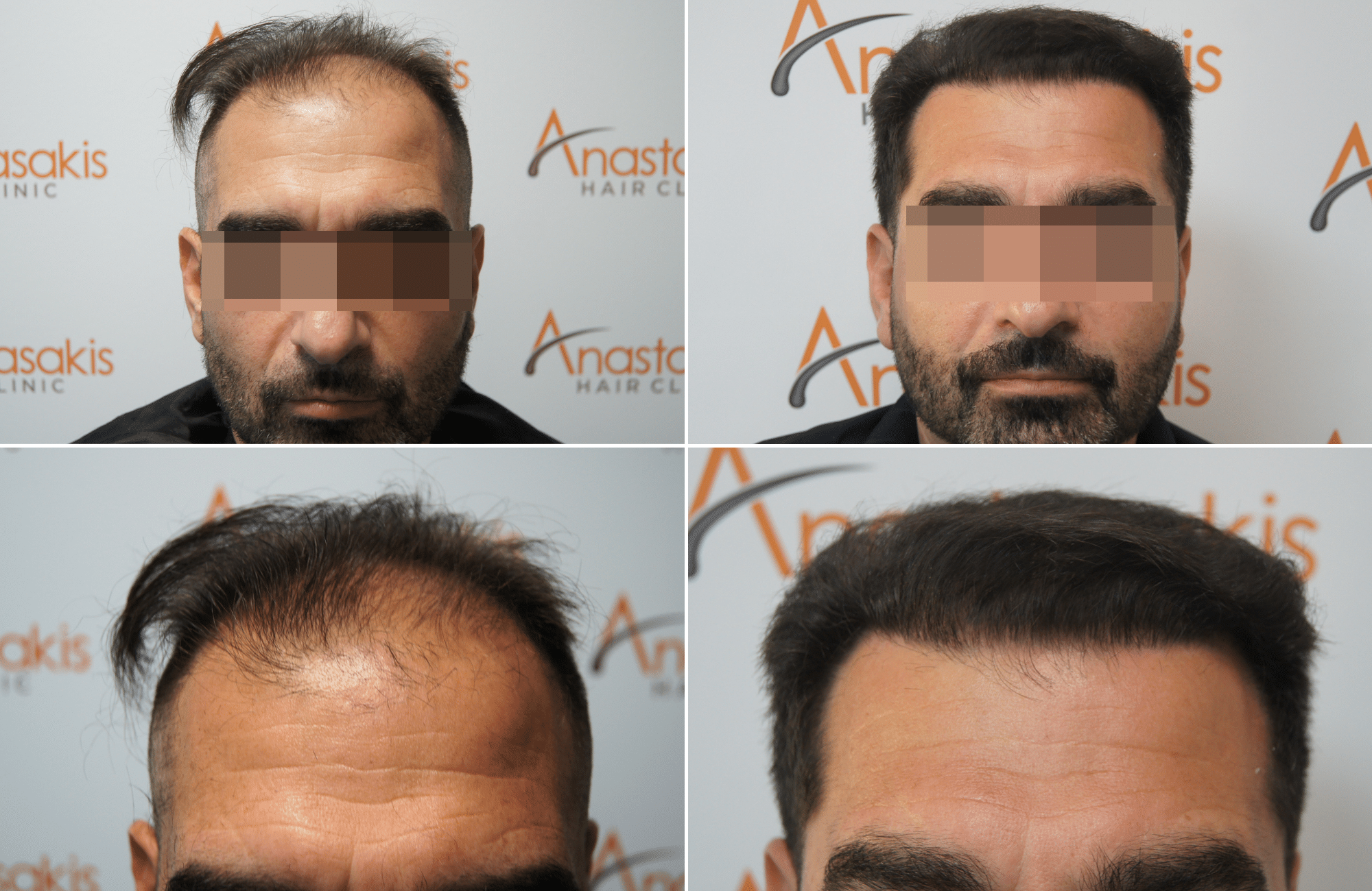 https://anastasakishairclinic.com/portfolio/apotelesma-metamosxefsis-mallion-anastasakis-hair-clinic-478/