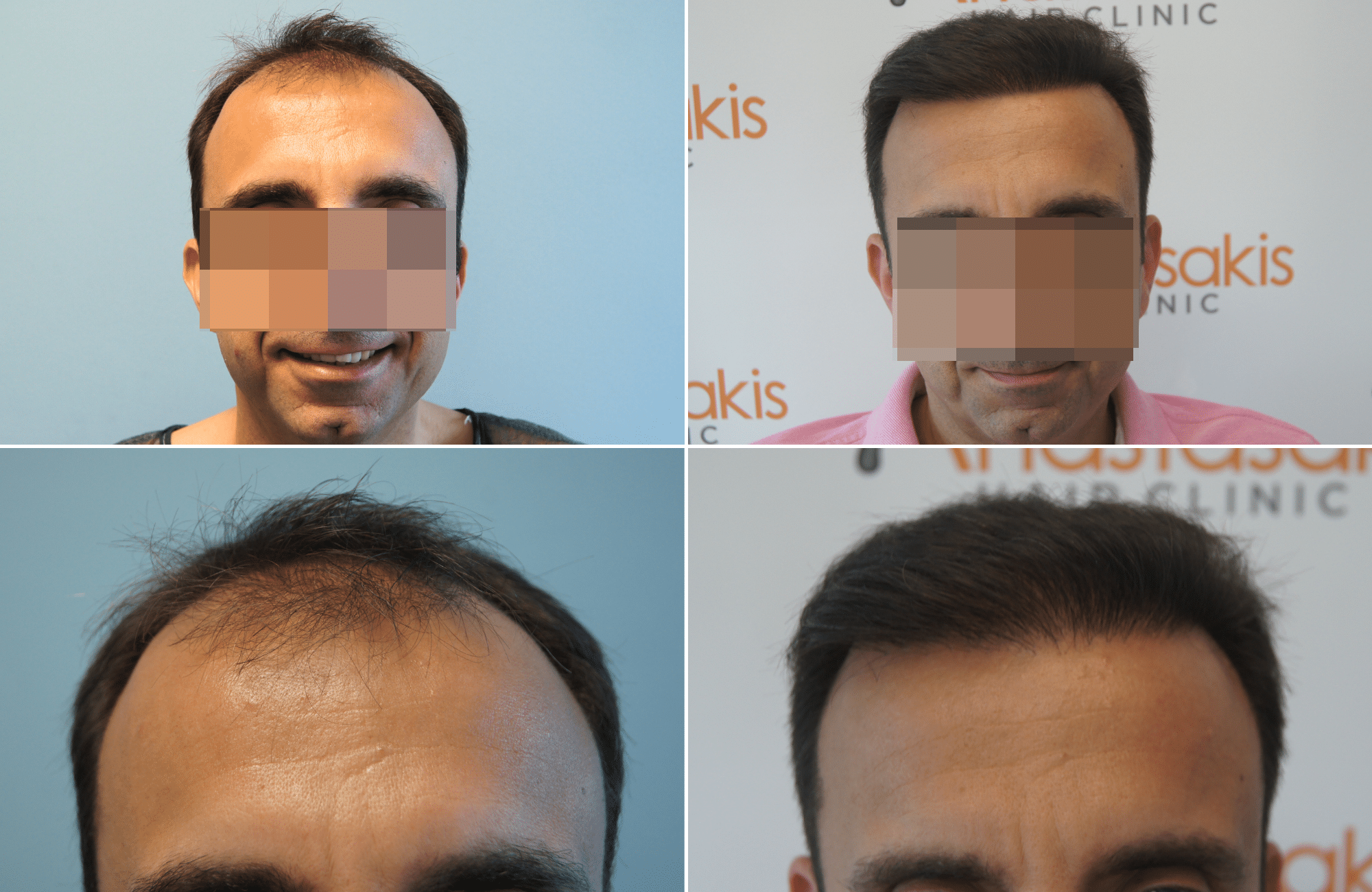 https://anastasakishairclinic.com/portfolio/apotelesma-metamosxefsis-mallion-anastasakis-hair-clinic-479/