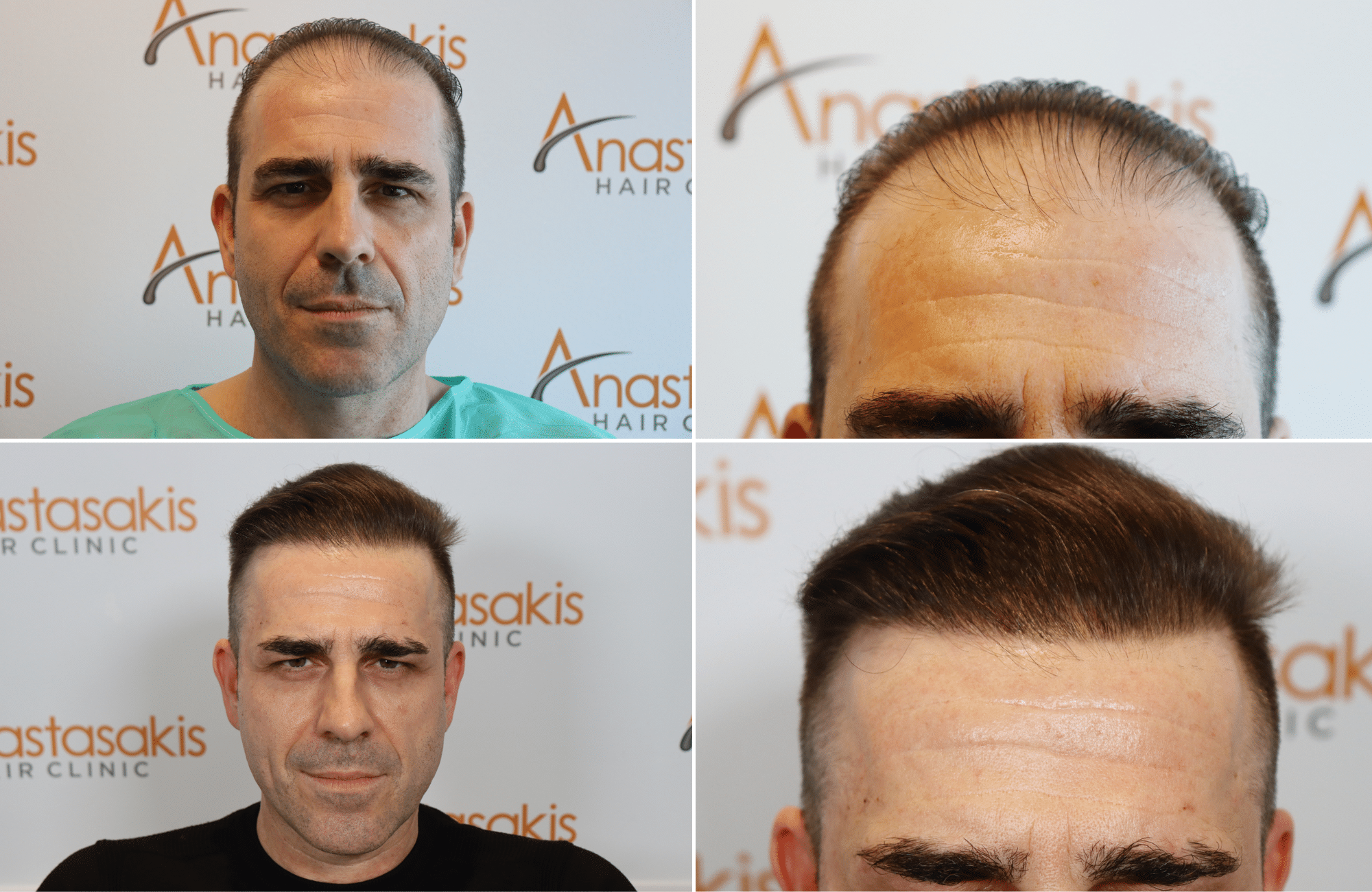 hair transplant result (2)