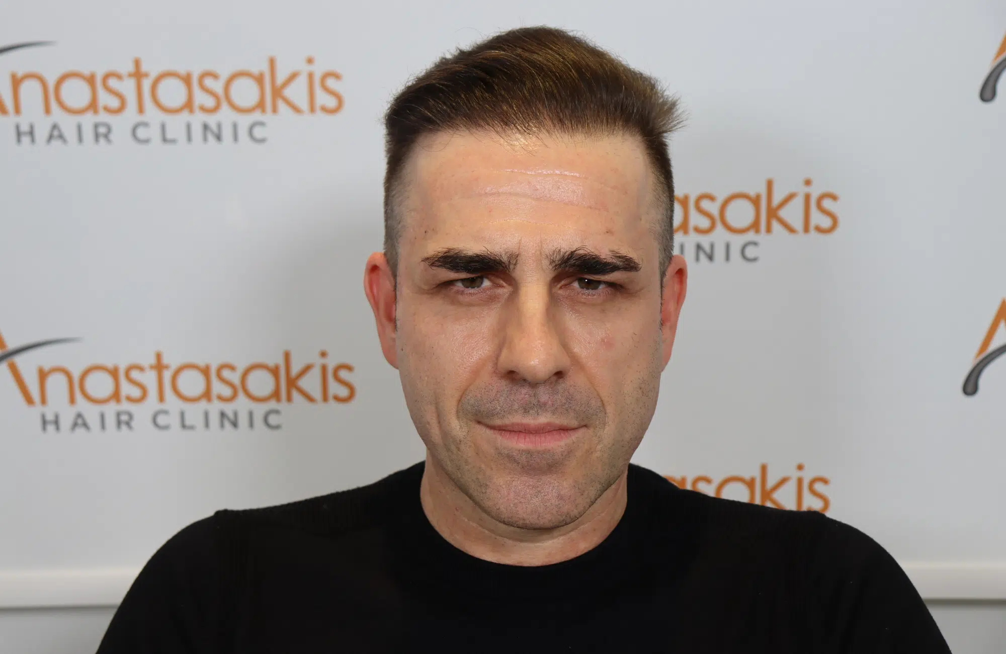 hair transplant result (3)