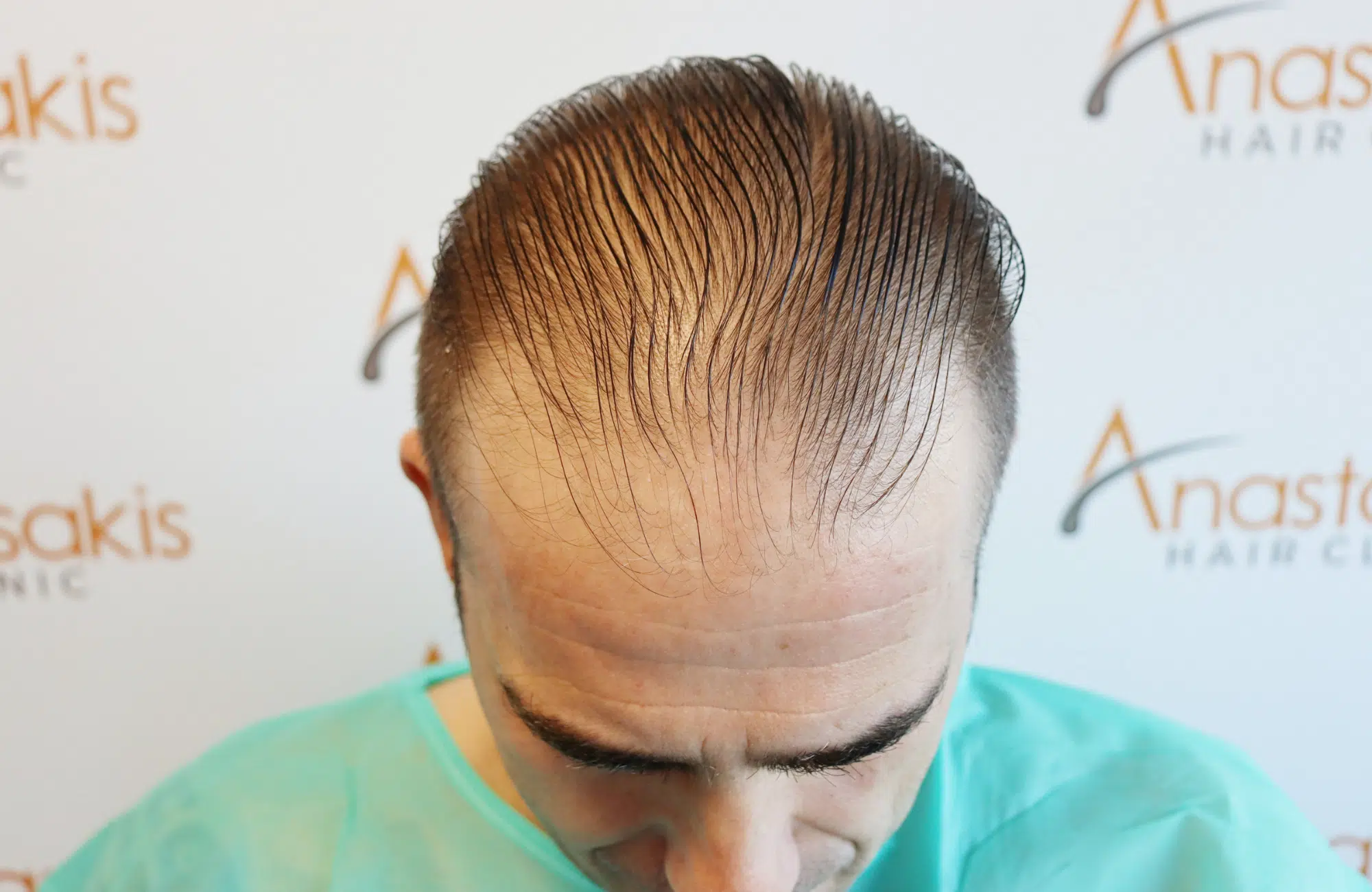 hair transplant result (9)