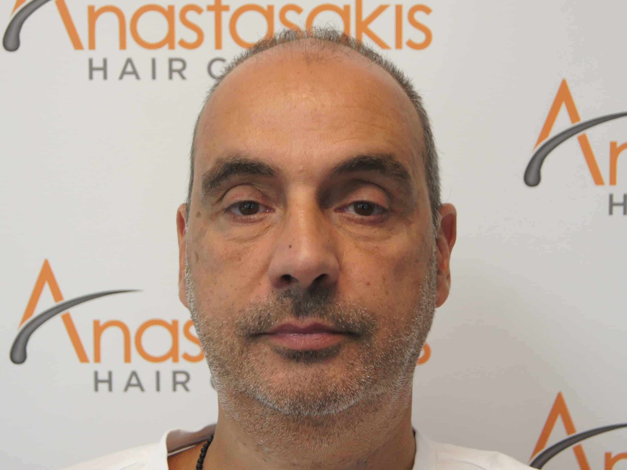 anastasakis hair clinic before hair transplant