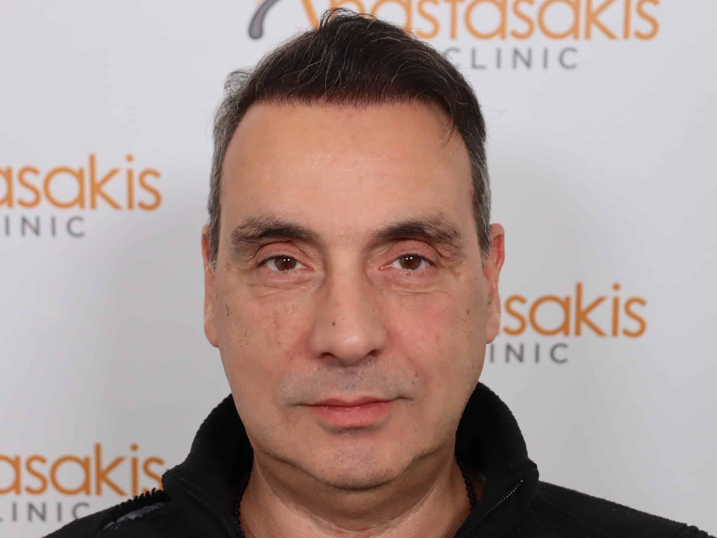 anastasakis hair clinic before hair transplant
