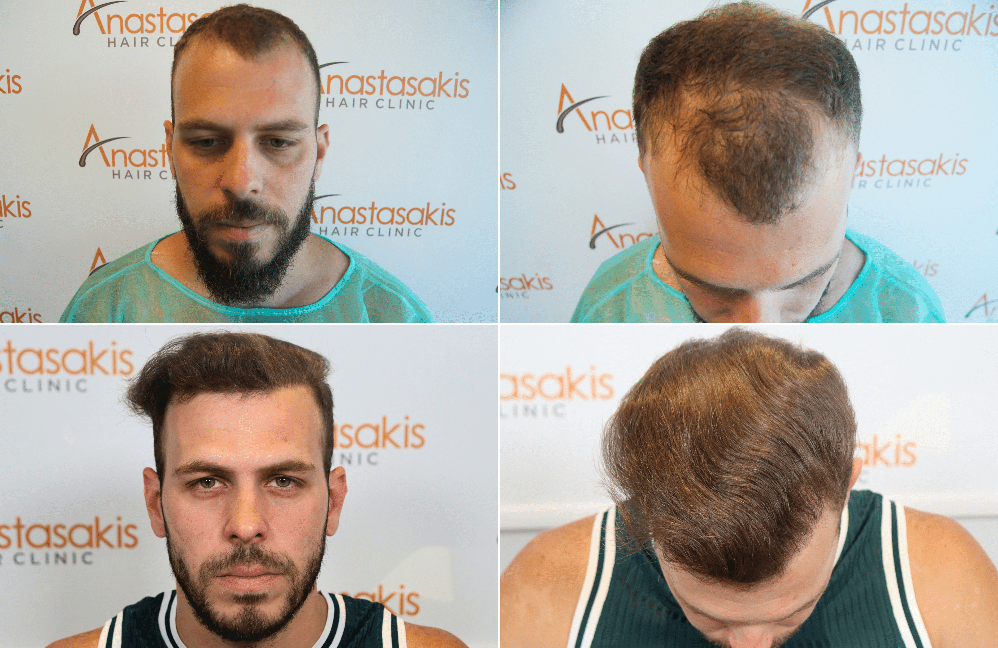 hair transplant