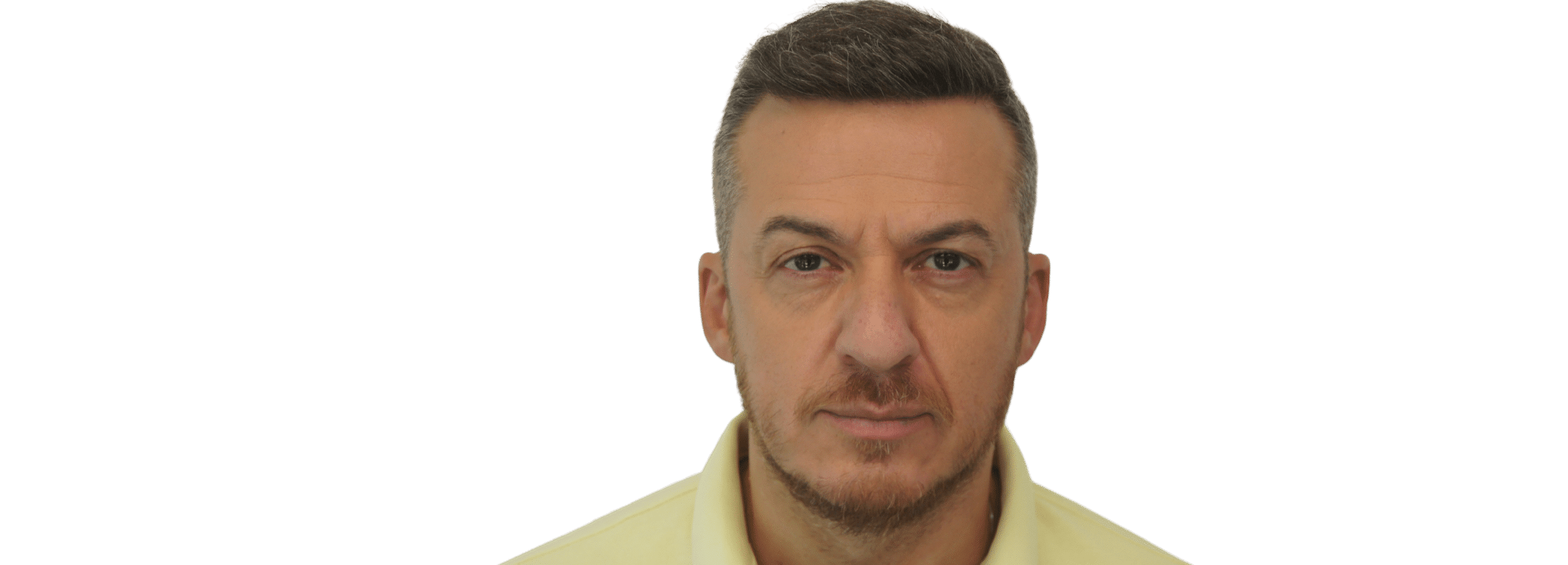 FUE Hair Transplant
