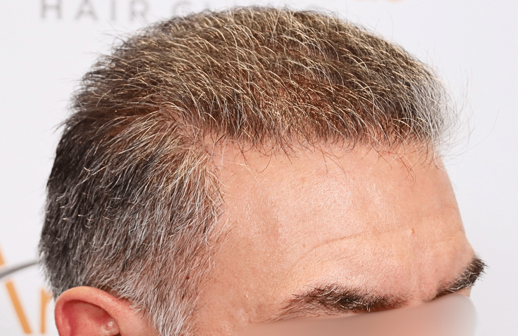 hair transplant result 3000 fus grey diffuse thin