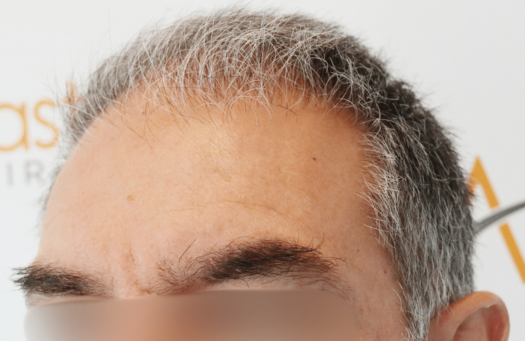 hair transplant result 3000 fus grey diffuse thin