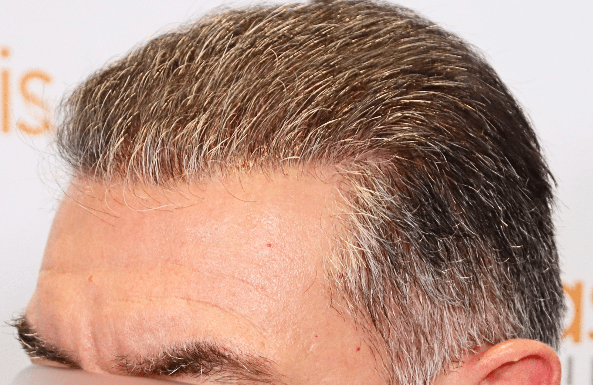 hair transplant result 3000 fus grey diffuse thin